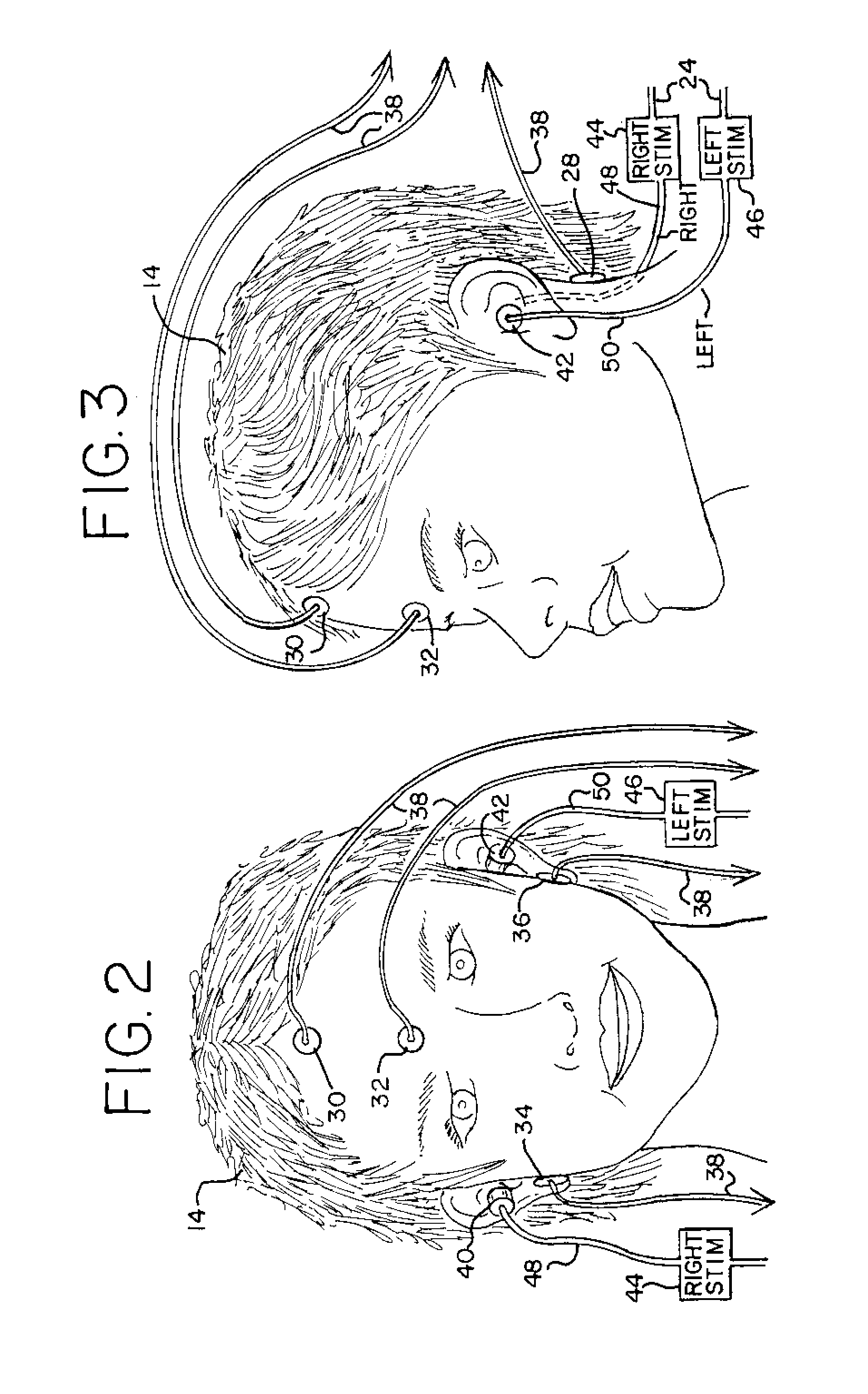 Non-invasive, bedside intra-cranial pressure monitoring system utilizing early on-set auditory evoked responses