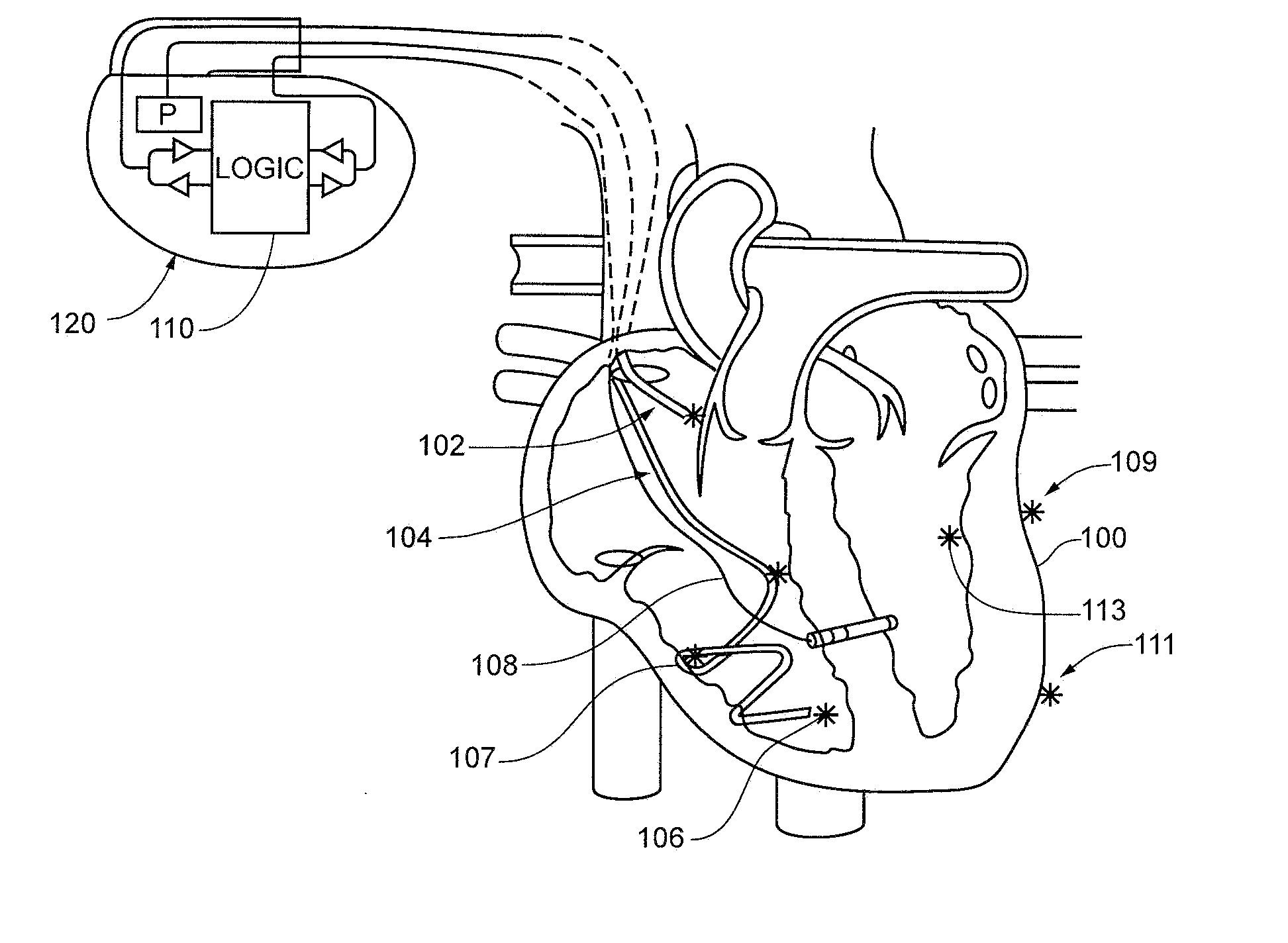 Cardiac Stimulation Apparatus And Method For The Control Of Hypertension