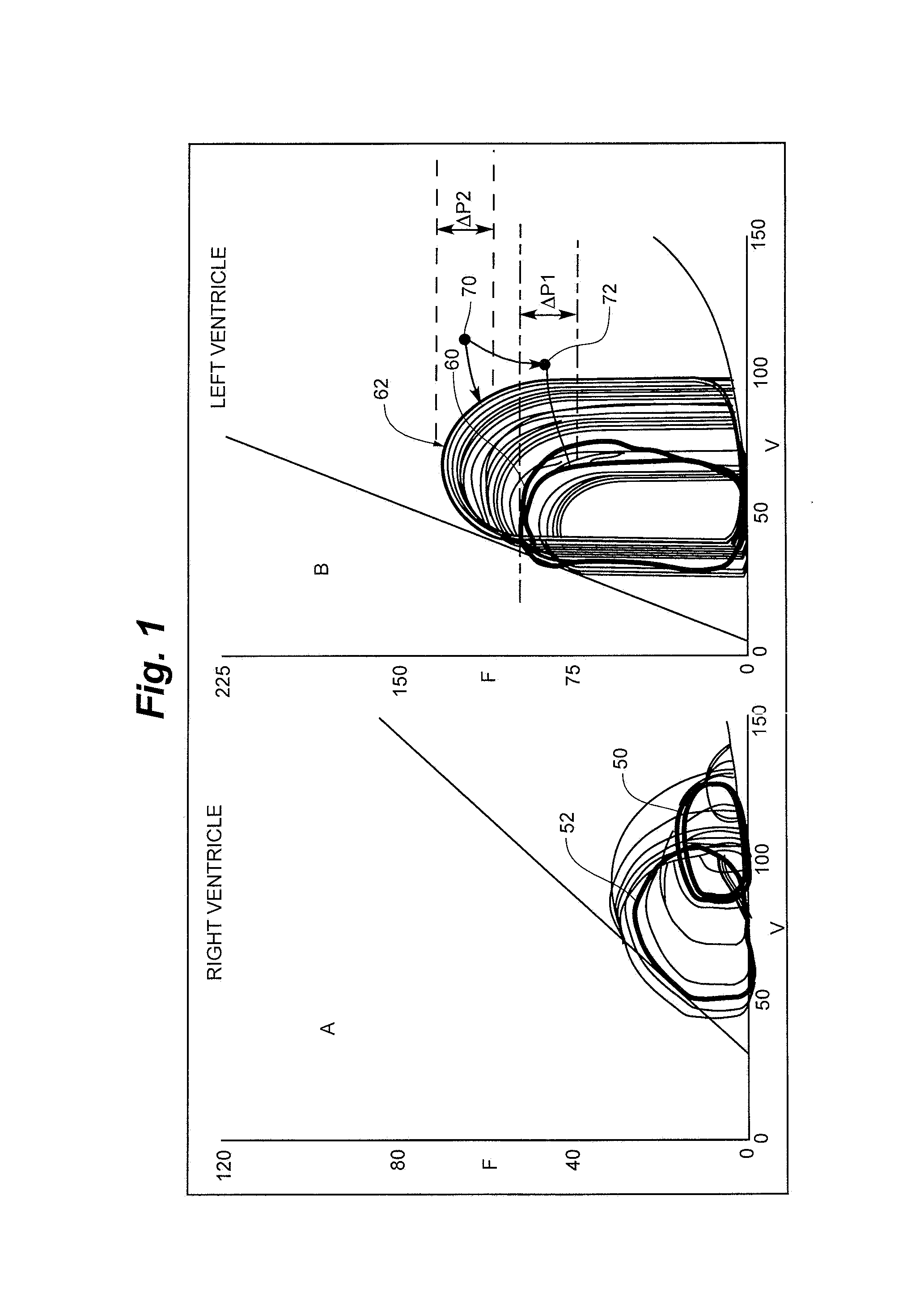 Cardiac Stimulation Apparatus And Method For The Control Of Hypertension