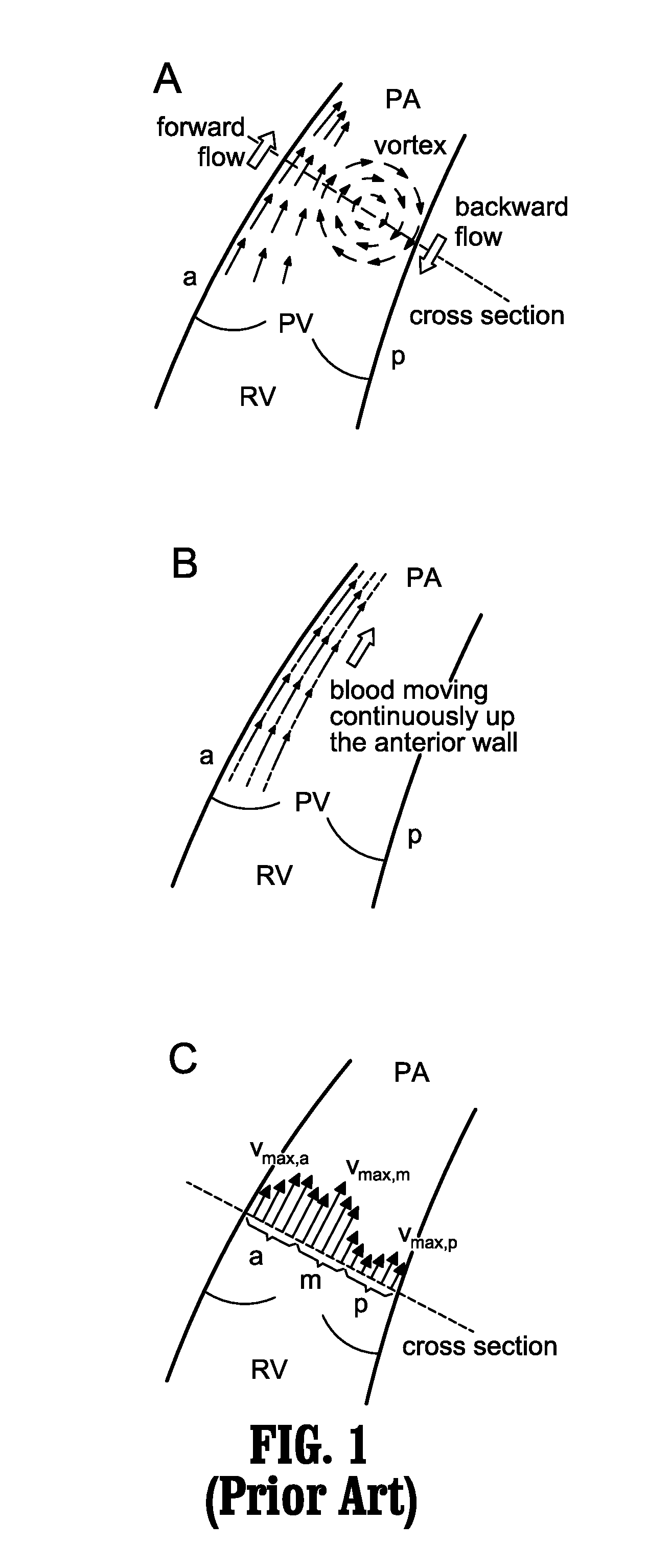 System and method for automatic, non-invasive diagnosis of pulmonary hypertension and measurement of mean pulmonary arterial pressure