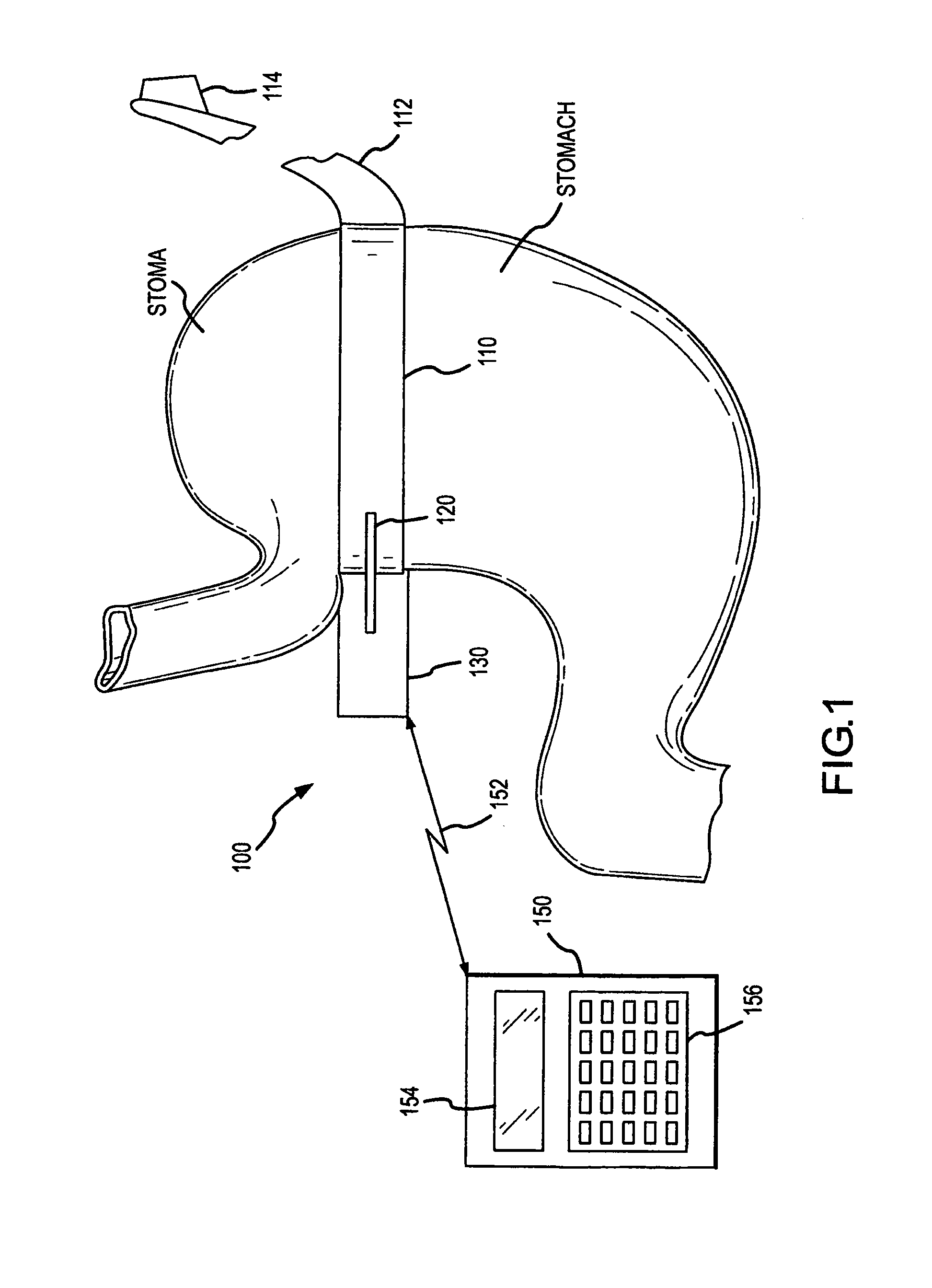 Self-regulating gastric band with pressure data processing