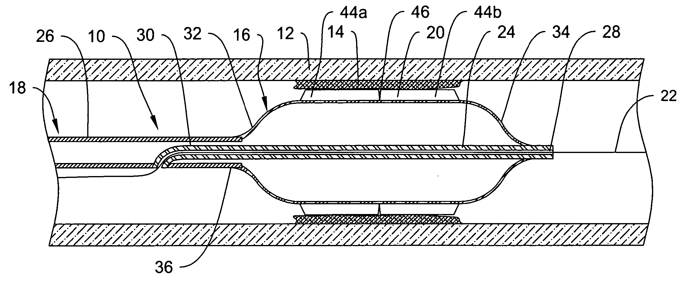 Cutting balloon catheter having a segmented blade