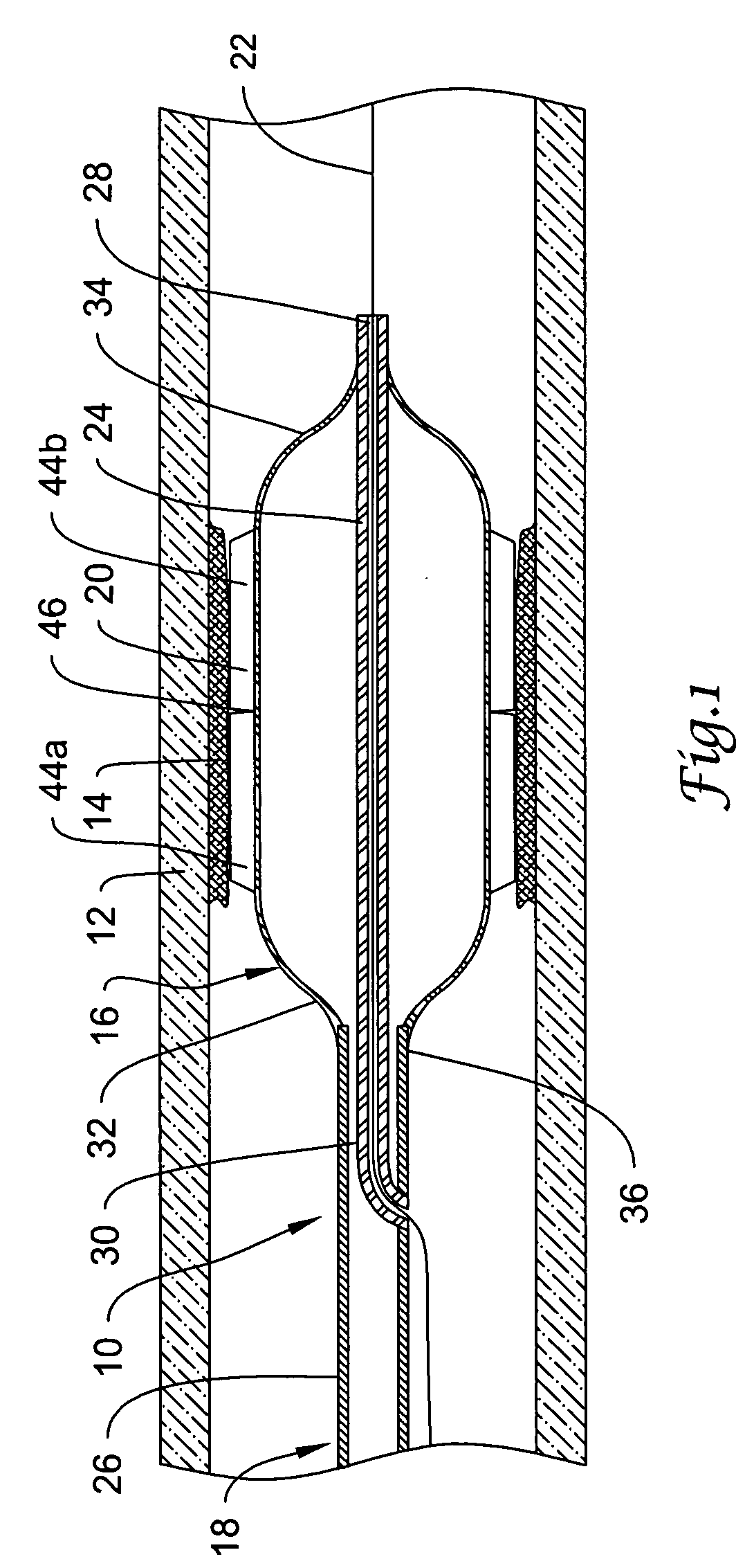 Cutting balloon catheter having a segmented blade