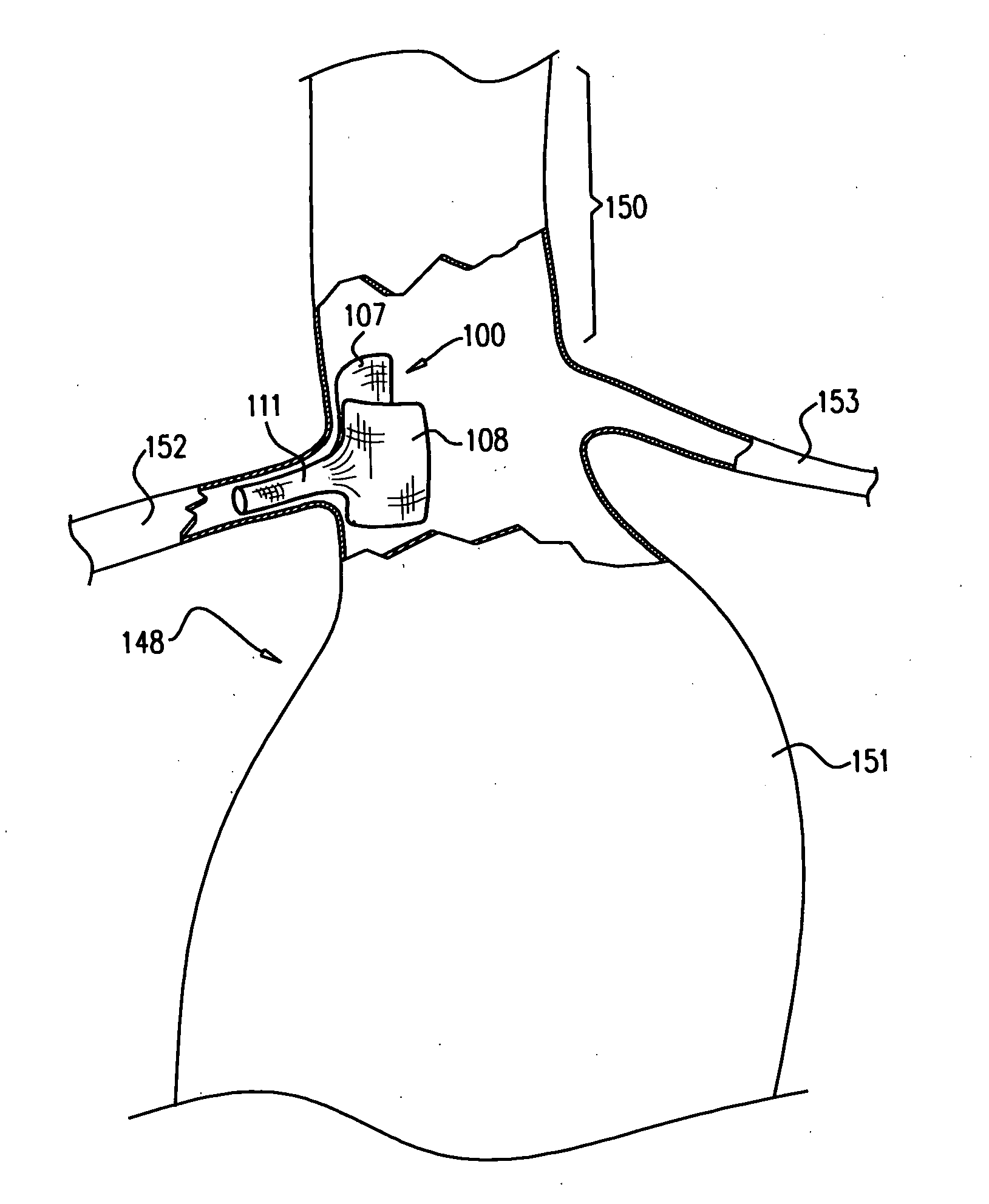 Treatment of a main body lumen in the vicinity of a branching body lumen