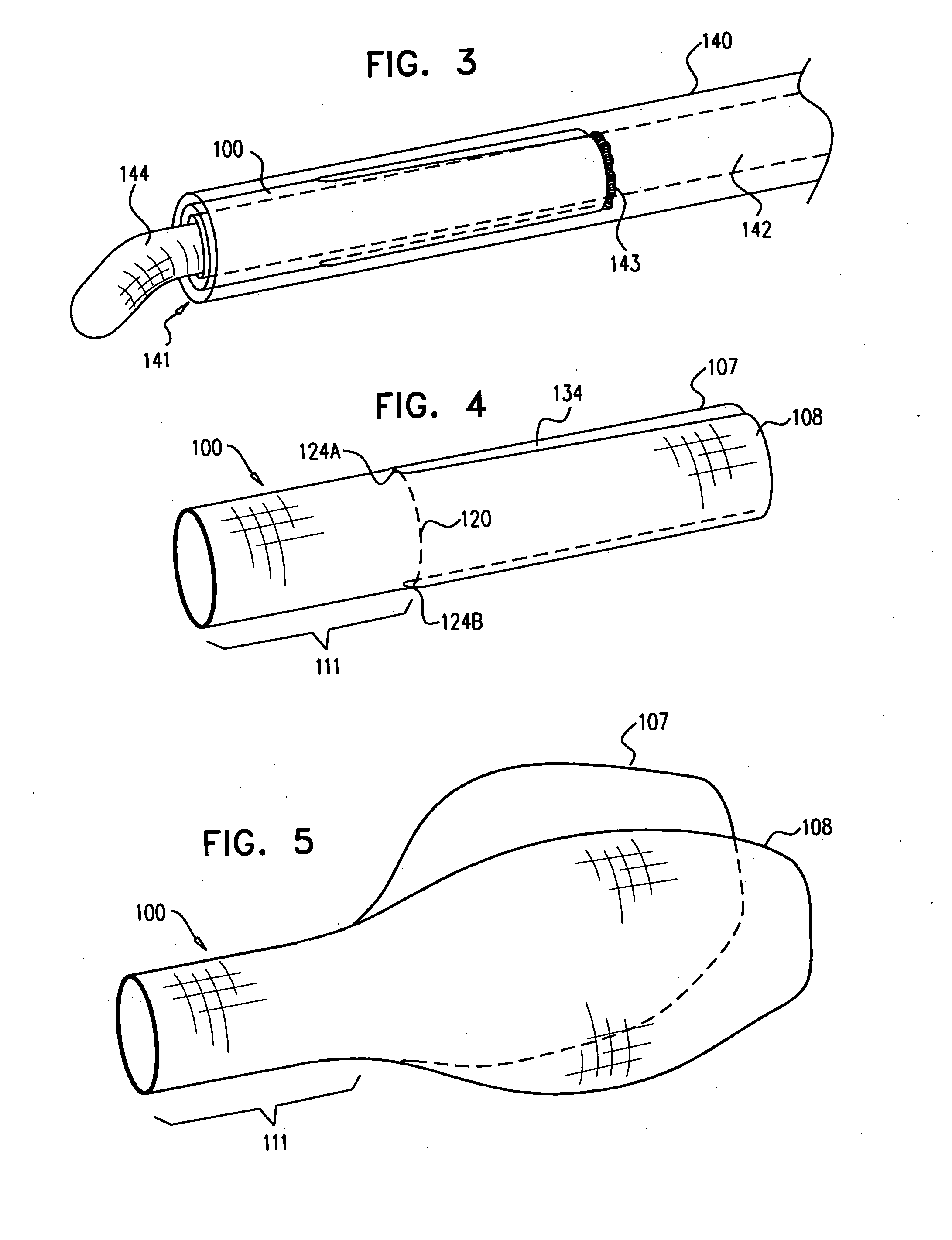 Treatment of a main body lumen in the vicinity of a branching body lumen