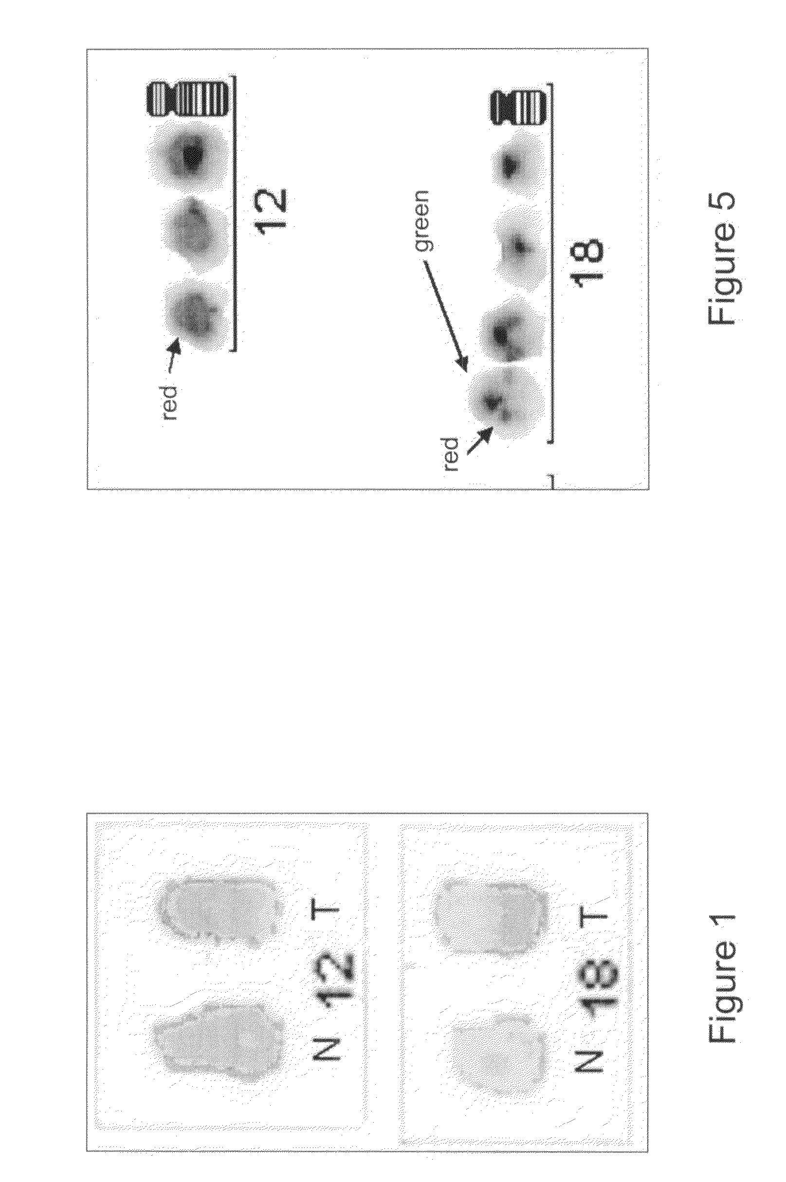 Method for the diagnosis of lymphoproliferative diseases