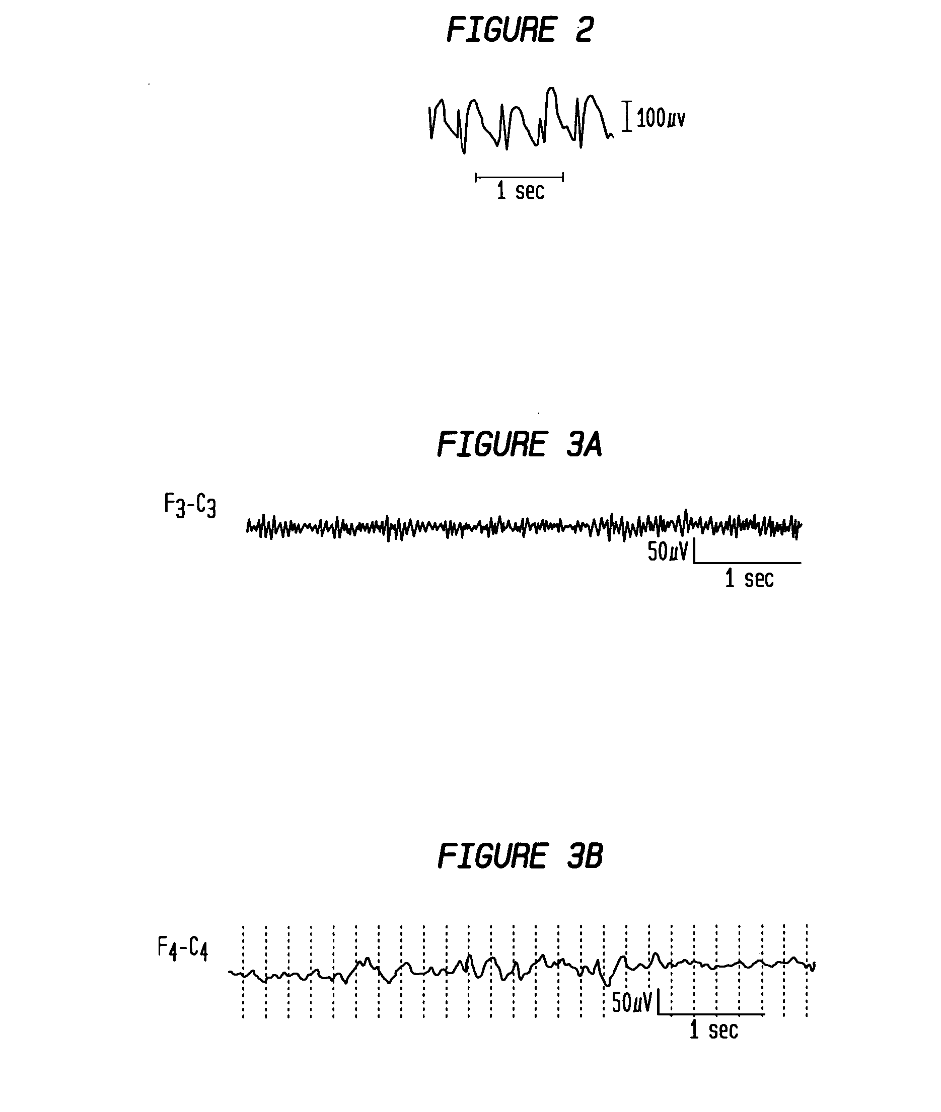 Patient-Specific Seizure Onset Detection System