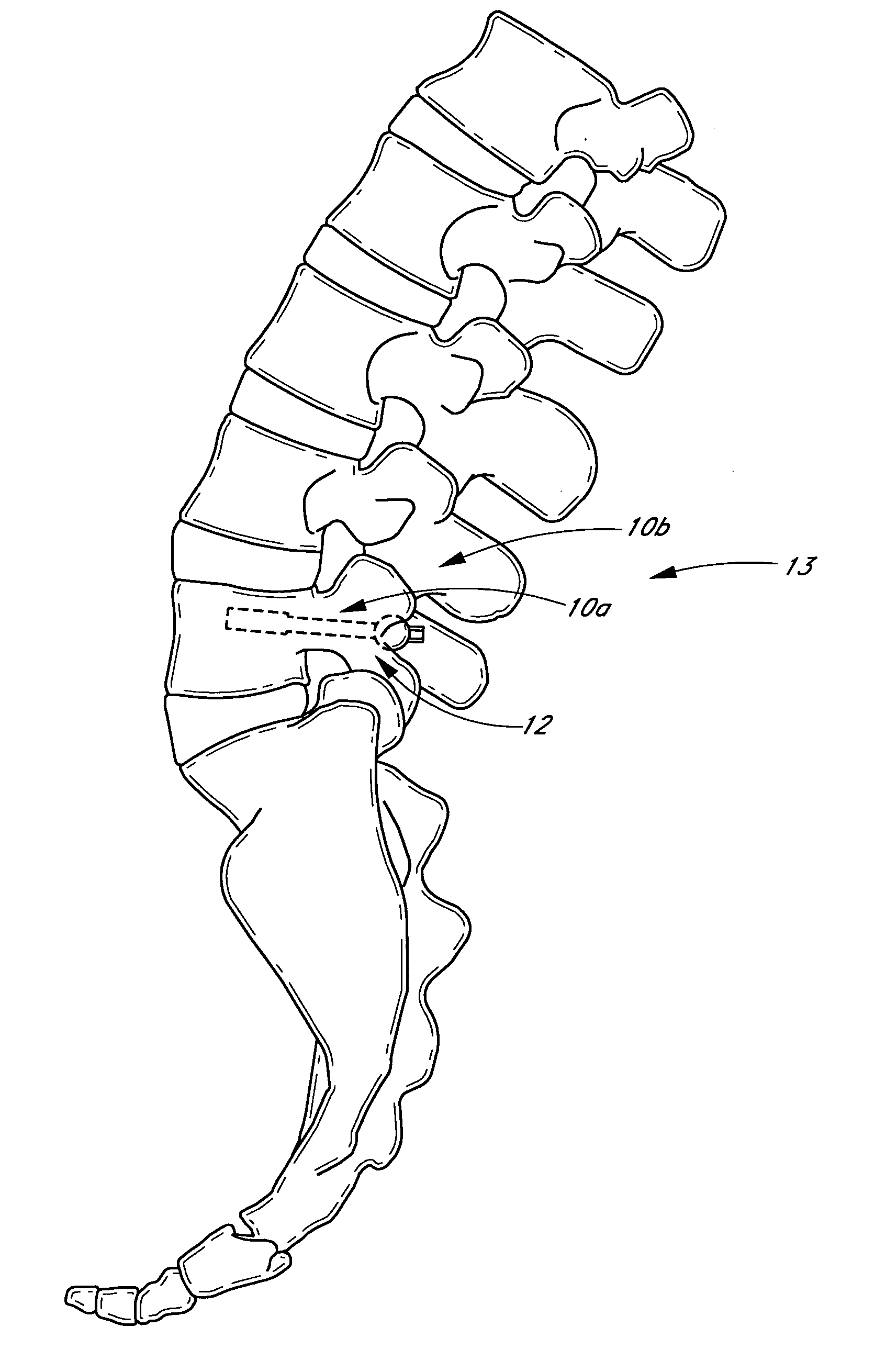 Method and apparatus for spinal stabilization