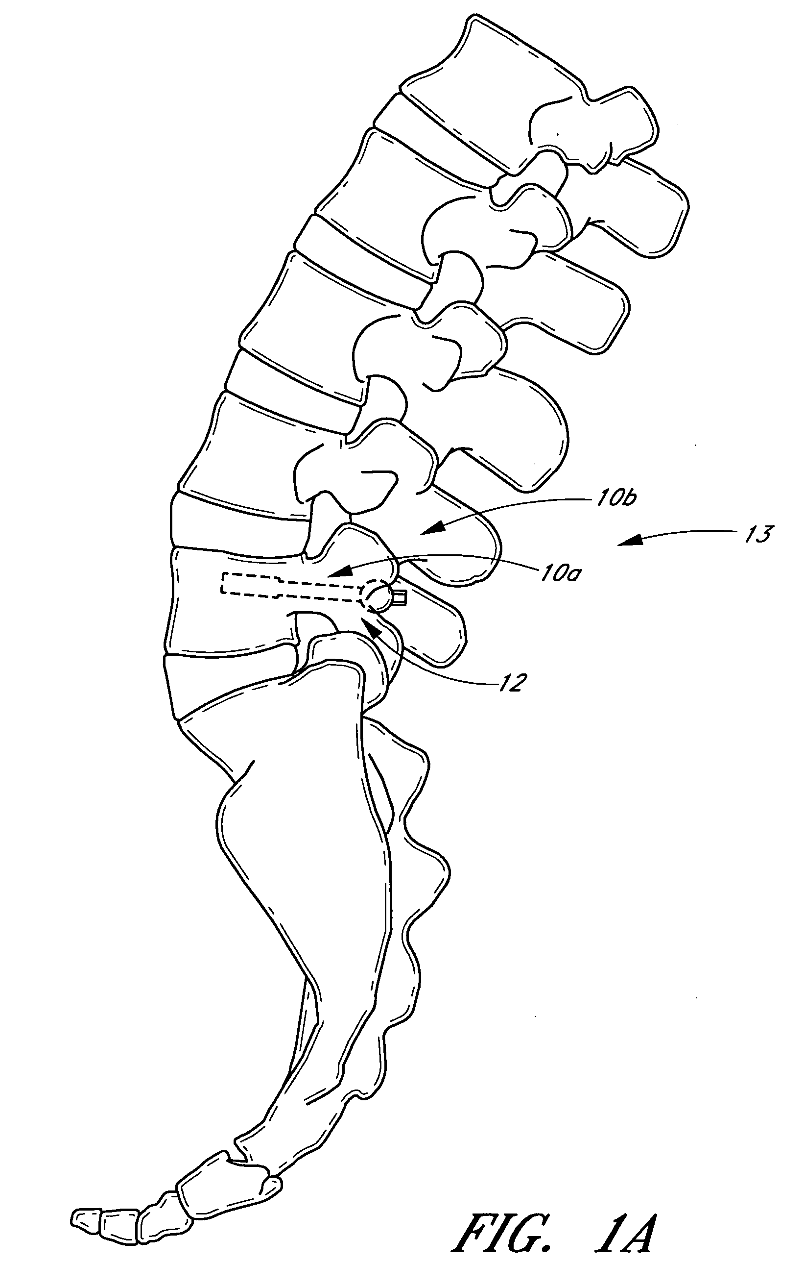 Method and apparatus for spinal stabilization