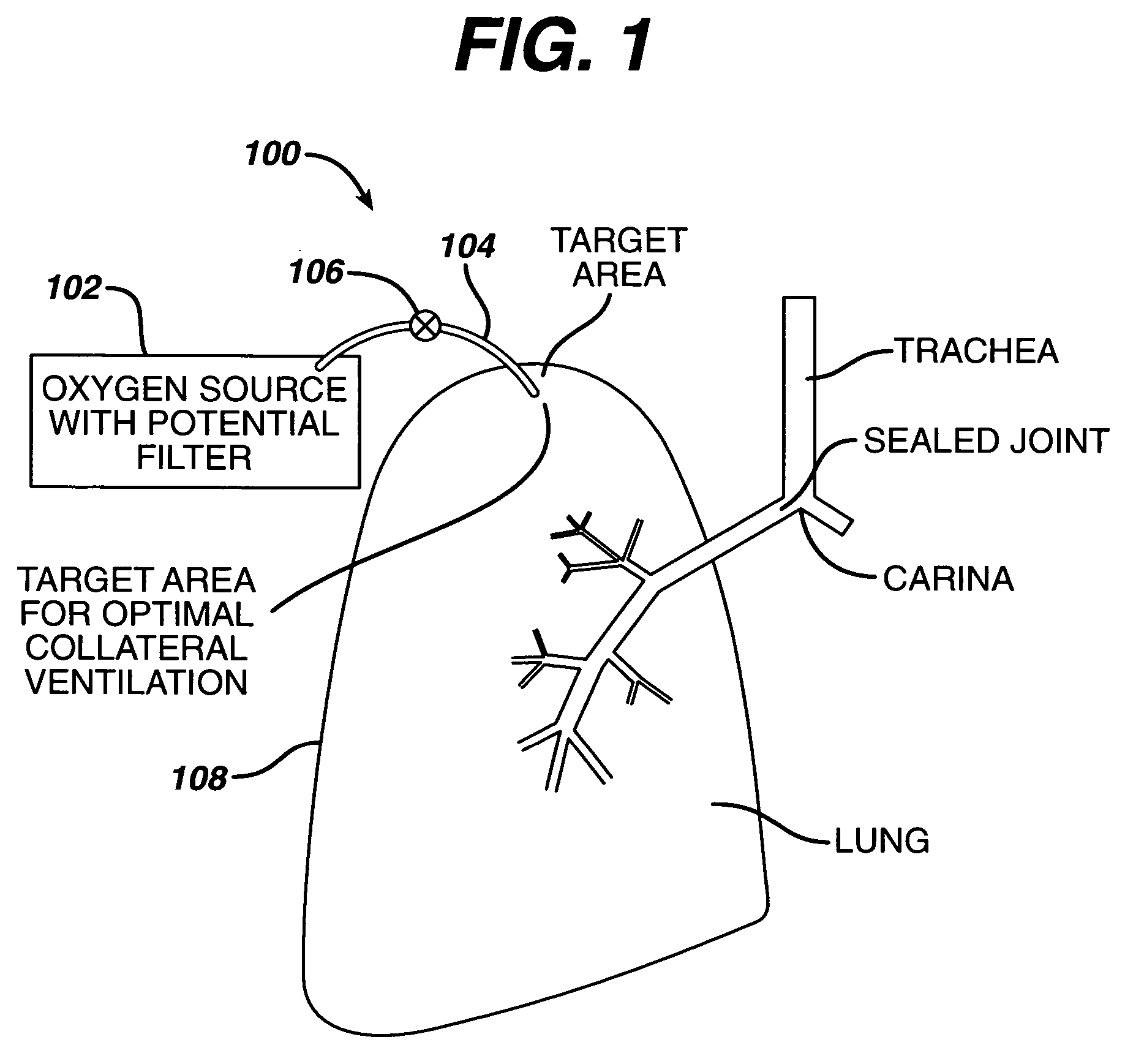 Localized pleurodesis evacuation device