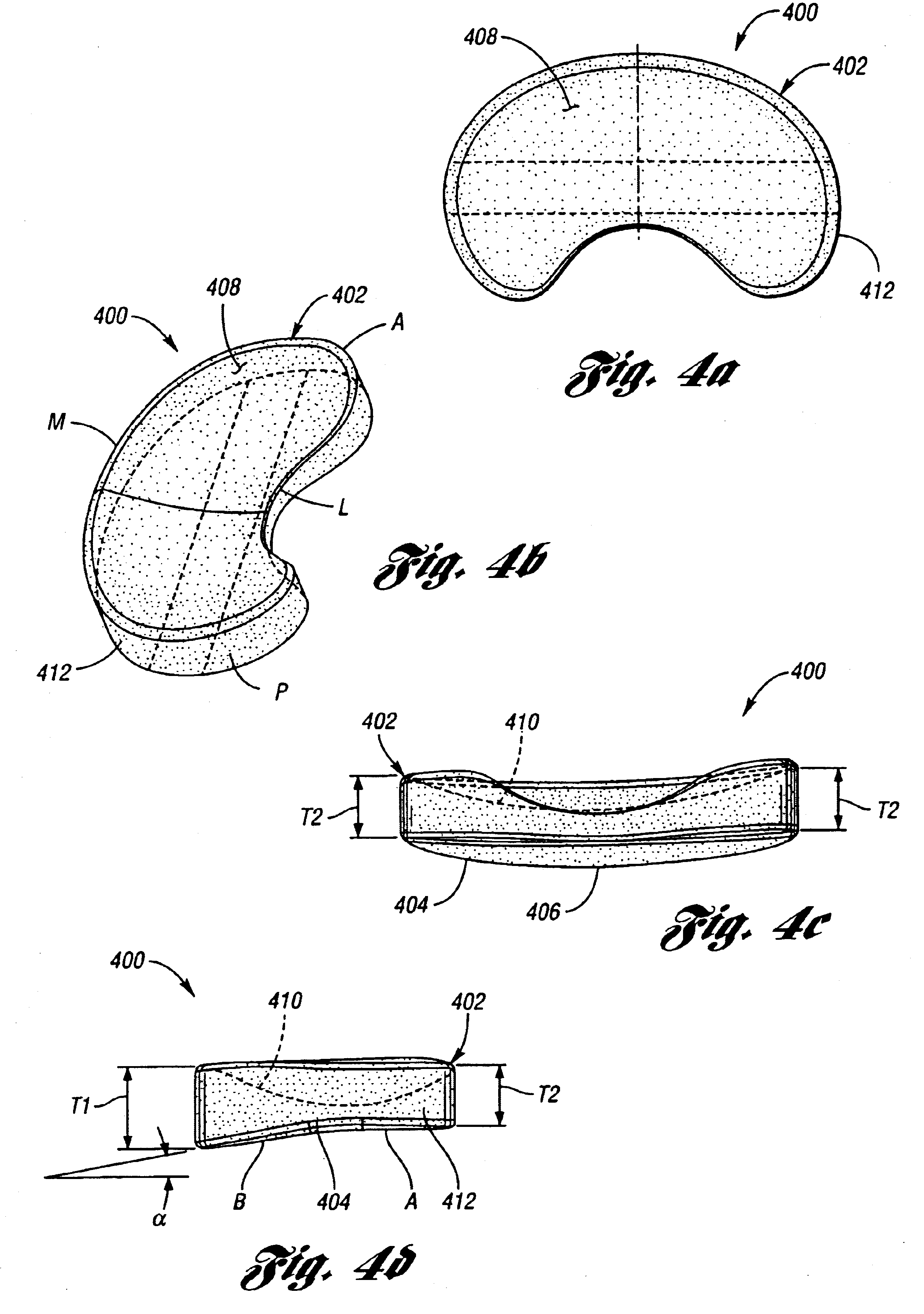 Surgically implantable knee prosthesis having medially shifted tibial surface