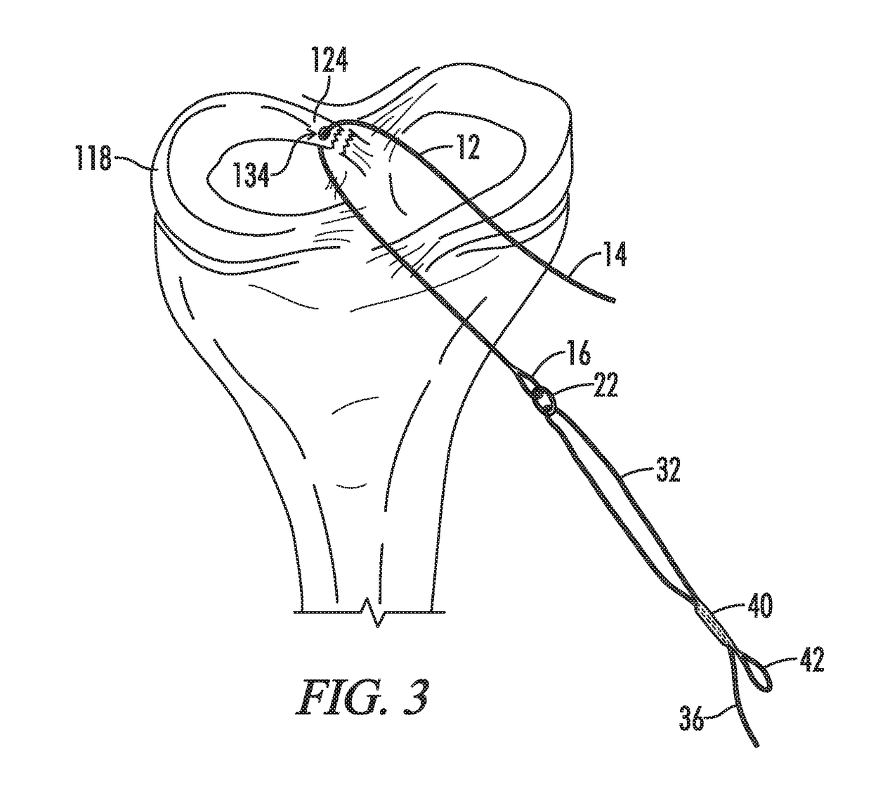 Self-cinching suture construct apparatus