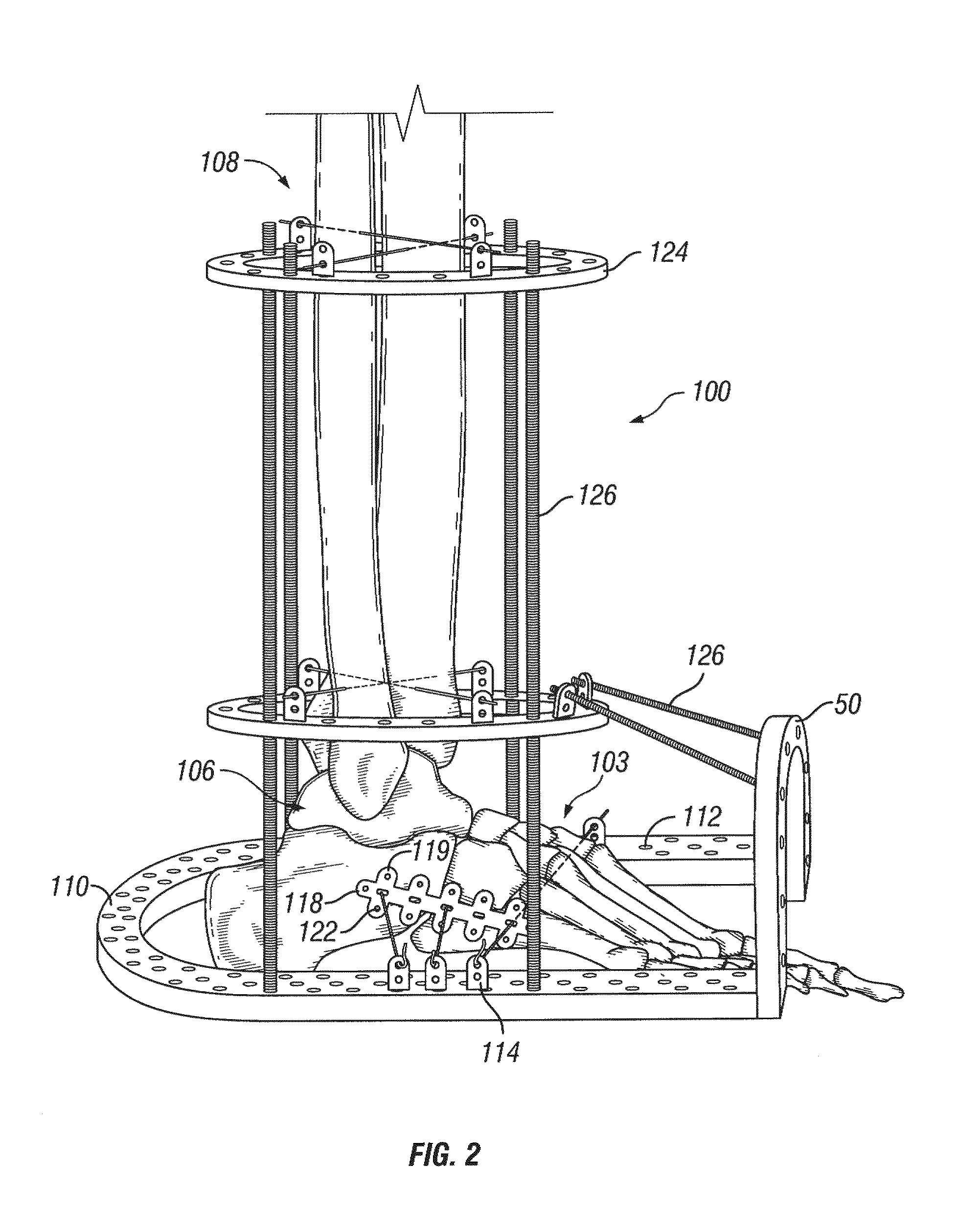 Foot, ankle and lower extremity compression and fixation system and related uses