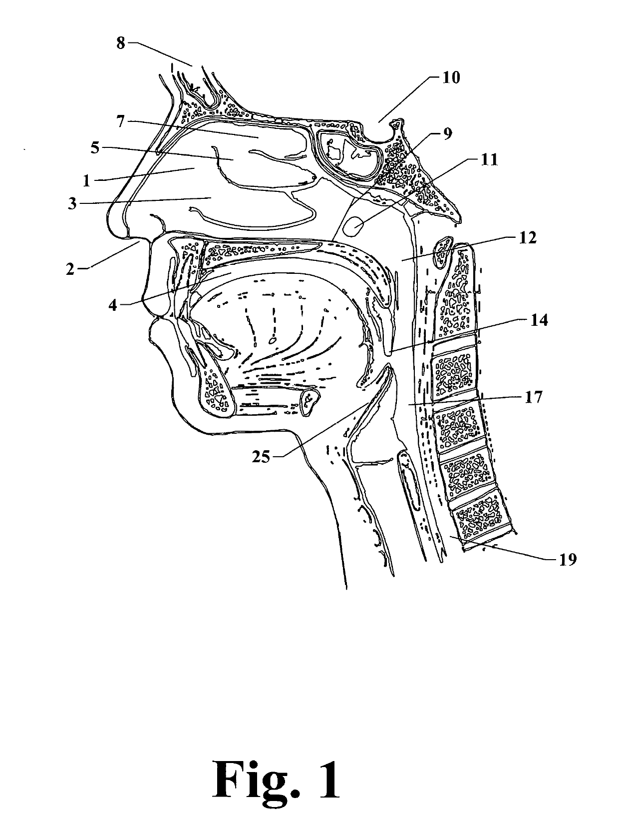 Method for enhancing eustachian tube patency and treatment of otitis media