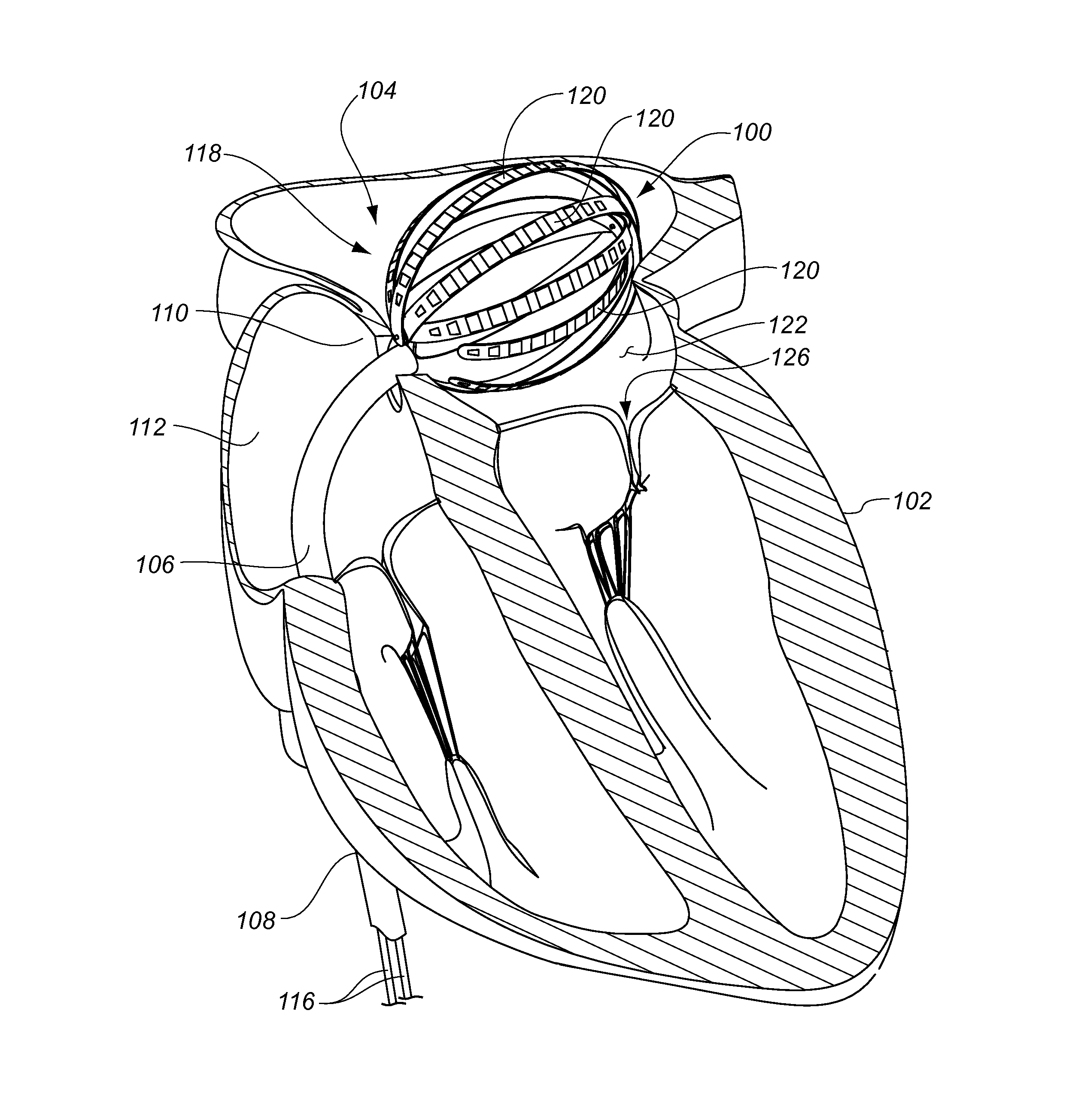 Intra-cardiac mapping and ablating