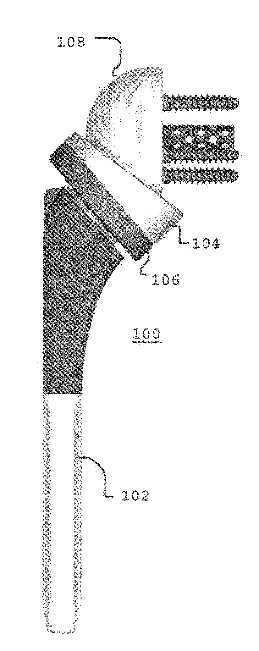 Reverse shoulder prosthesis