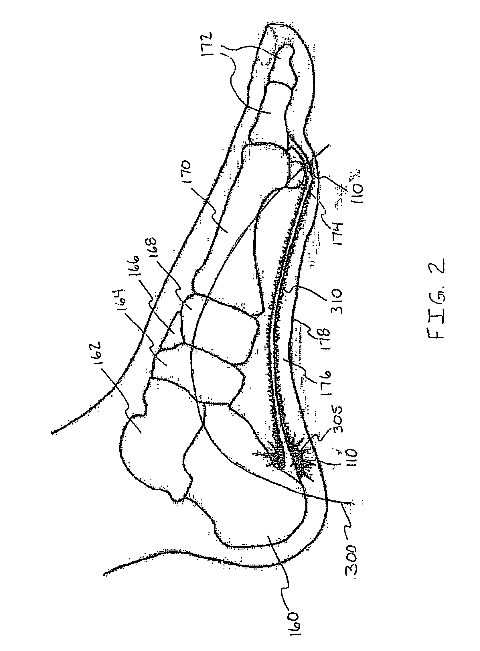 System for treatment of plantar fasciitis