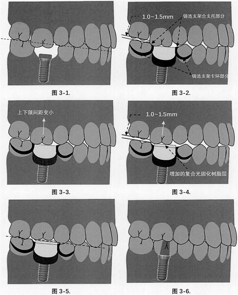 Moving device and method for depressing overlong maxillary posterior teeth