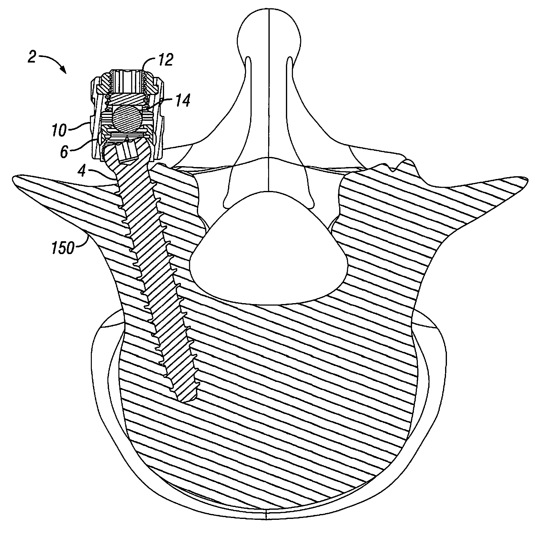 Orthopedic fixation devices and methods of installation thereof