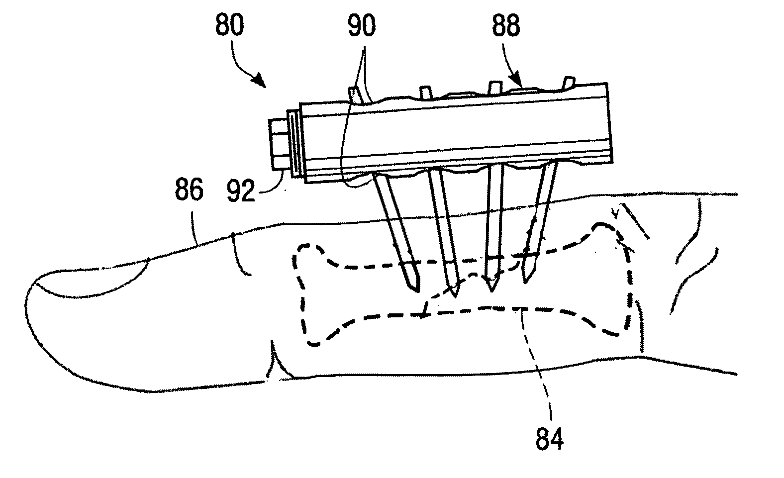 Apparatus for external fixation of a fractured distal radius with angularly adjustable pin clamping means