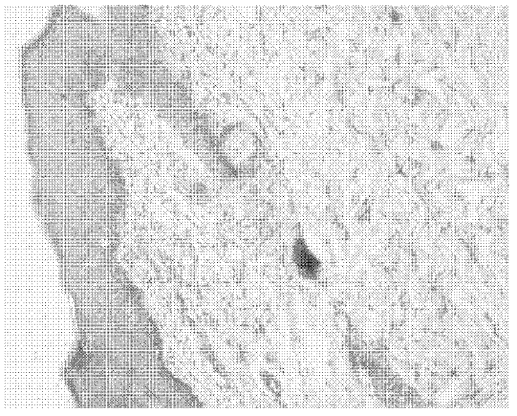 Compound pharmaceutical composition of iodine polymer and glucocorticosteroid for treating dermatitis