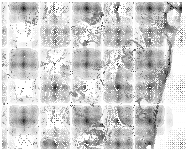 Compound pharmaceutical composition of iodine polymer and glucocorticosteroid for treating dermatitis