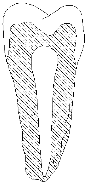 NiTi memory personalized self-expansion thread groove embedded porous structure dental implant and preparation method thereof