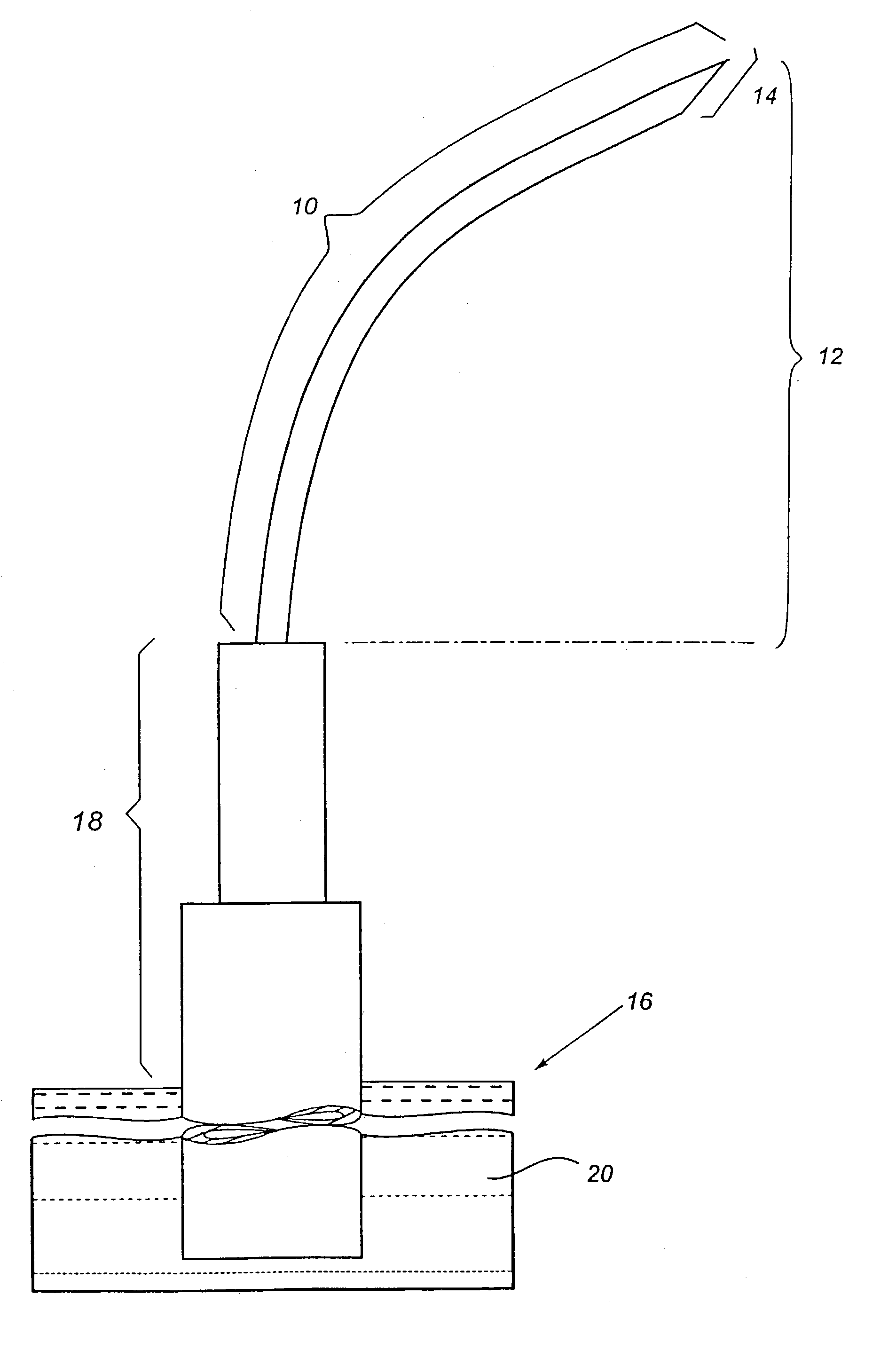 Apparatus for performing surgery inside the human retina using fluidic internal limiting membrane (ILM) separation (FILMS)