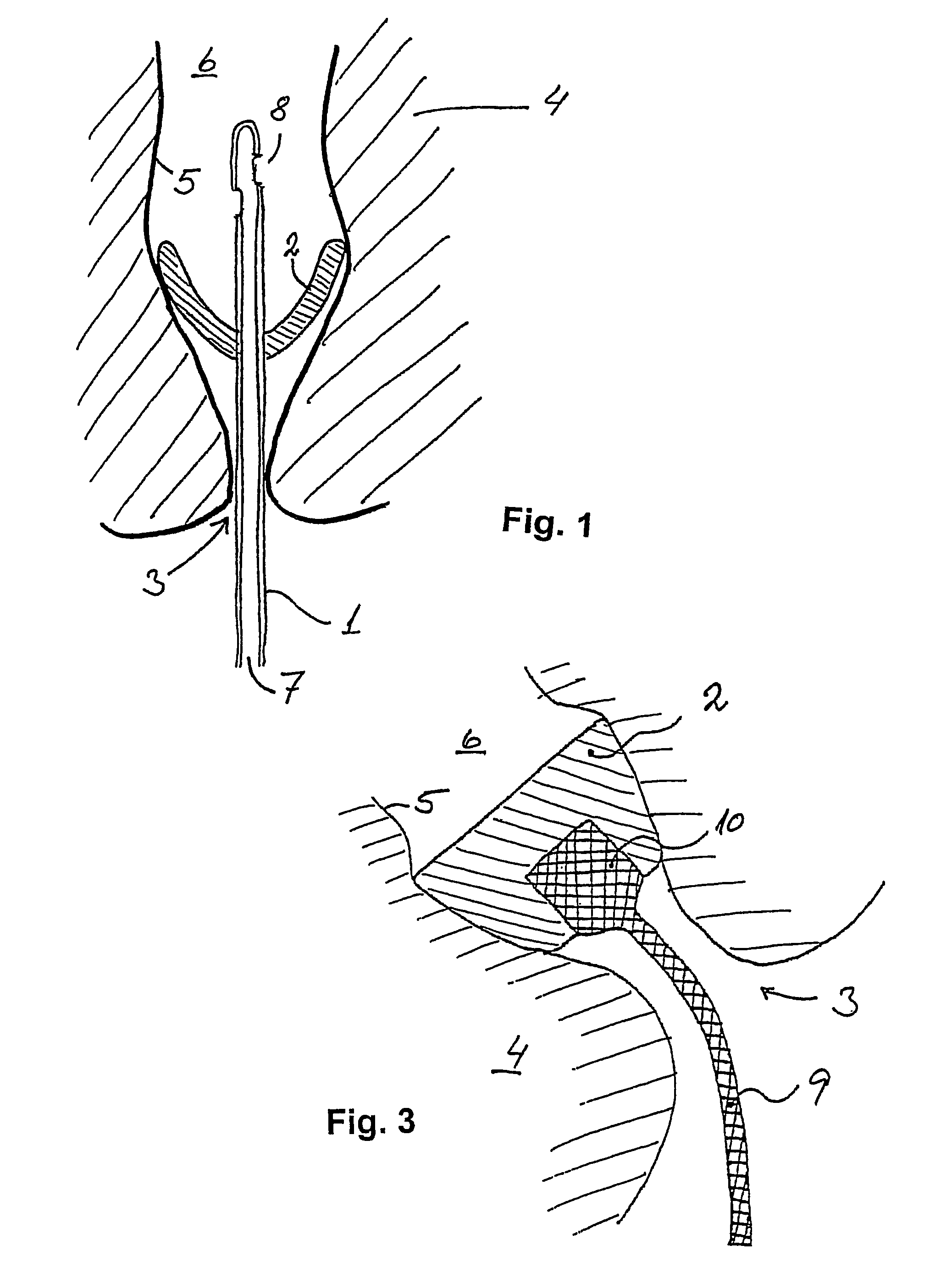 Sealing device