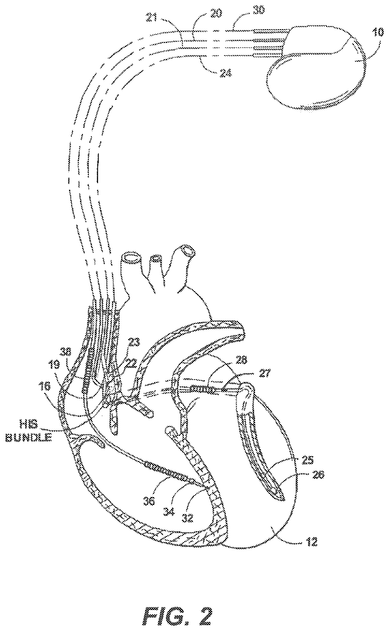 Systems and methods for automated capture threshold testing and associated his bundle pacing