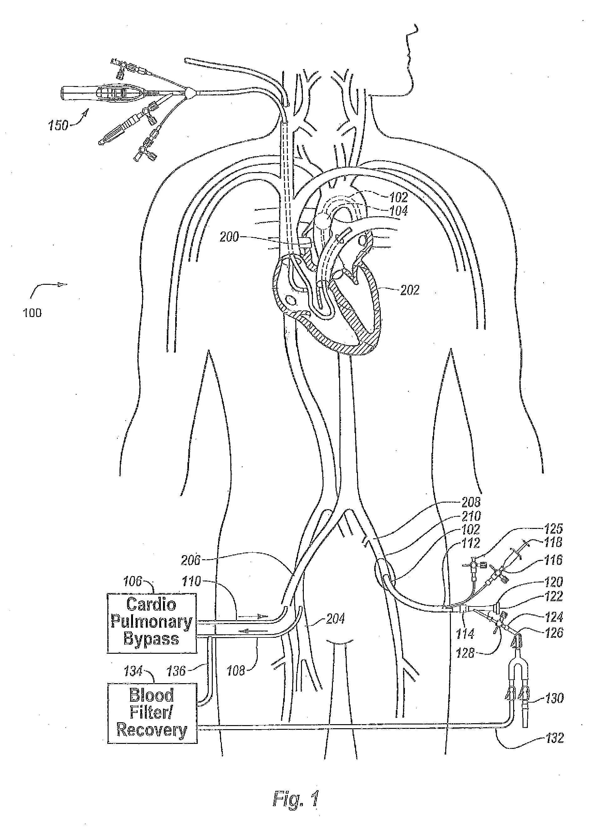 Aortic Occlusion Catheter