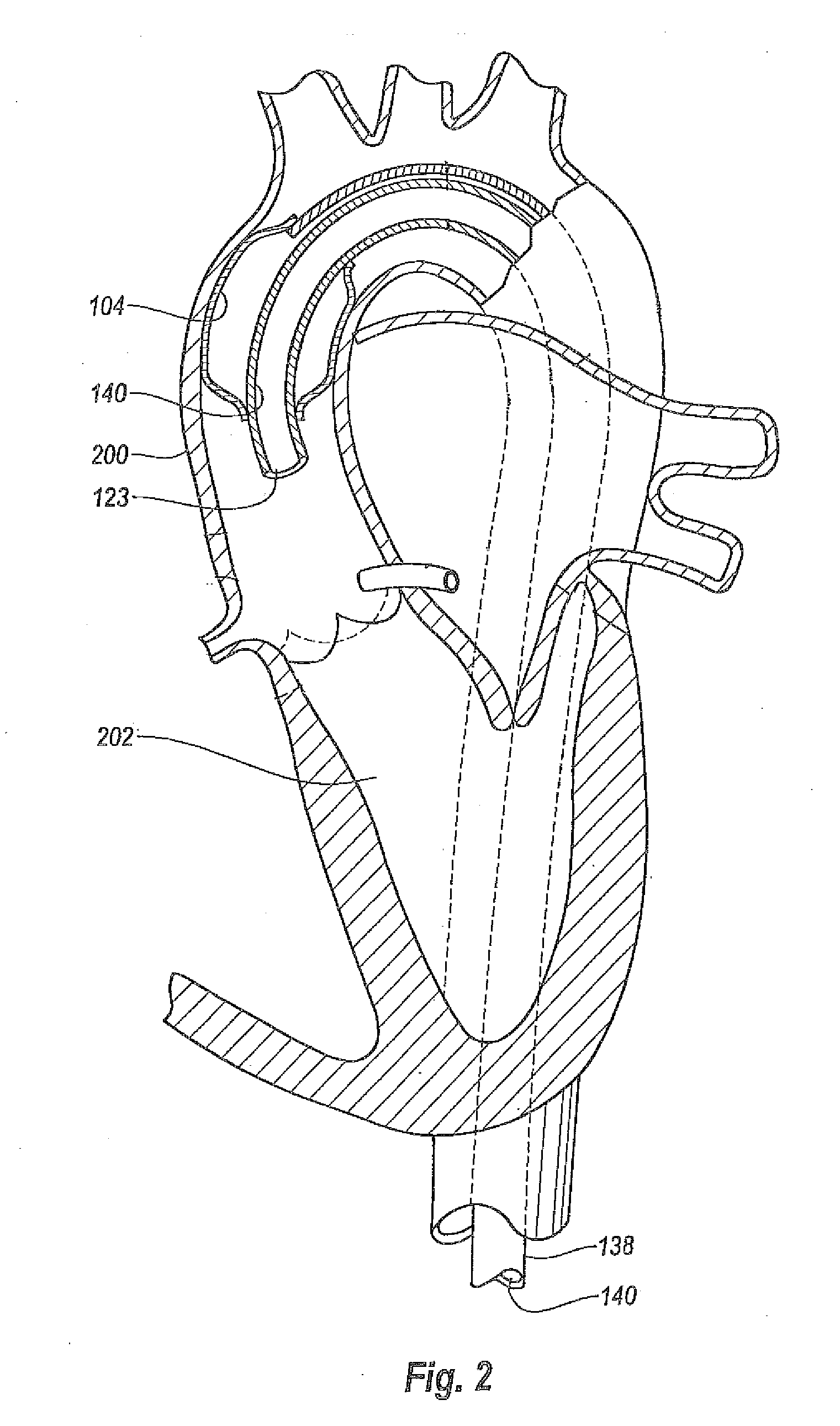 Aortic Occlusion Catheter