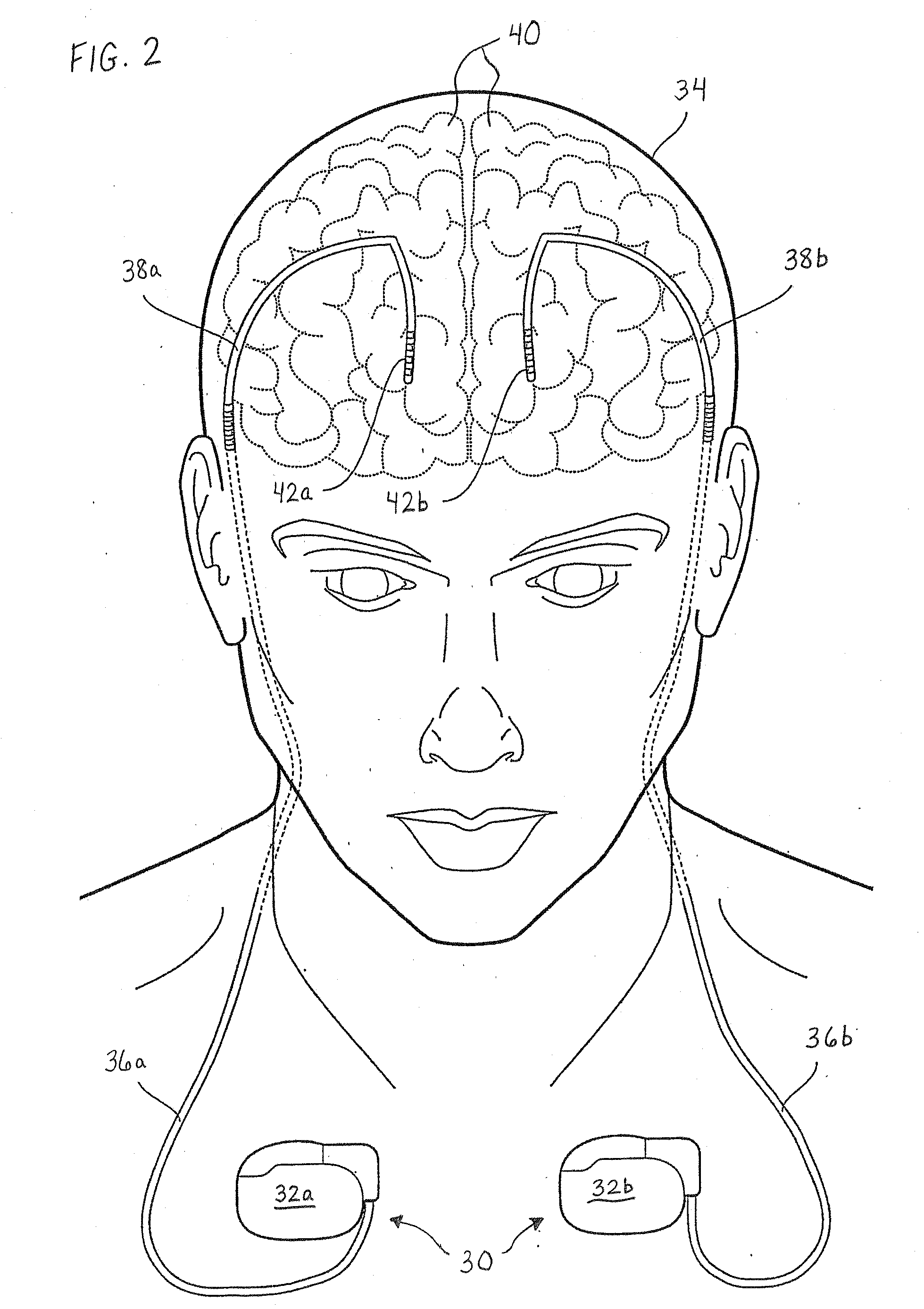 Continuous conductive materials for electromagnetic shielding