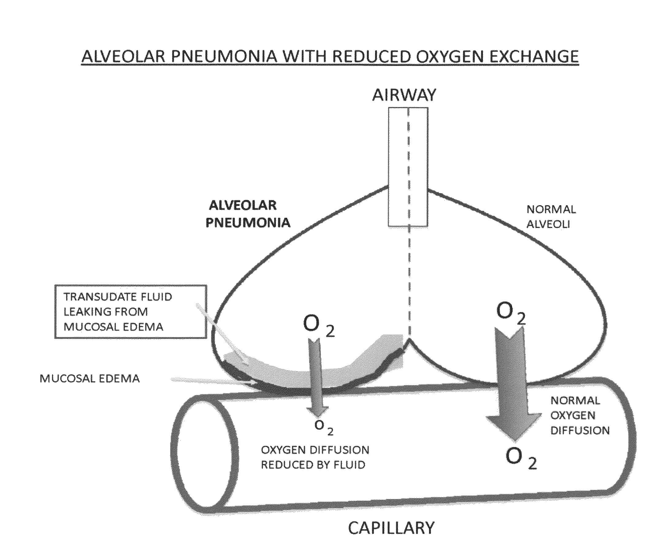 Compositions and methods for treatment of pulmonary diseases and conditions