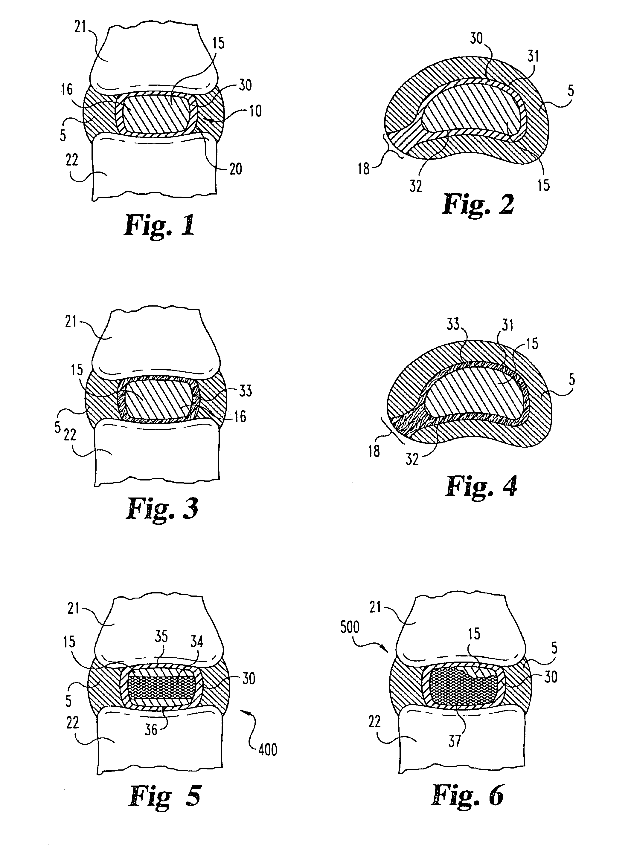 Intervertebral disc nucleus implants and methods