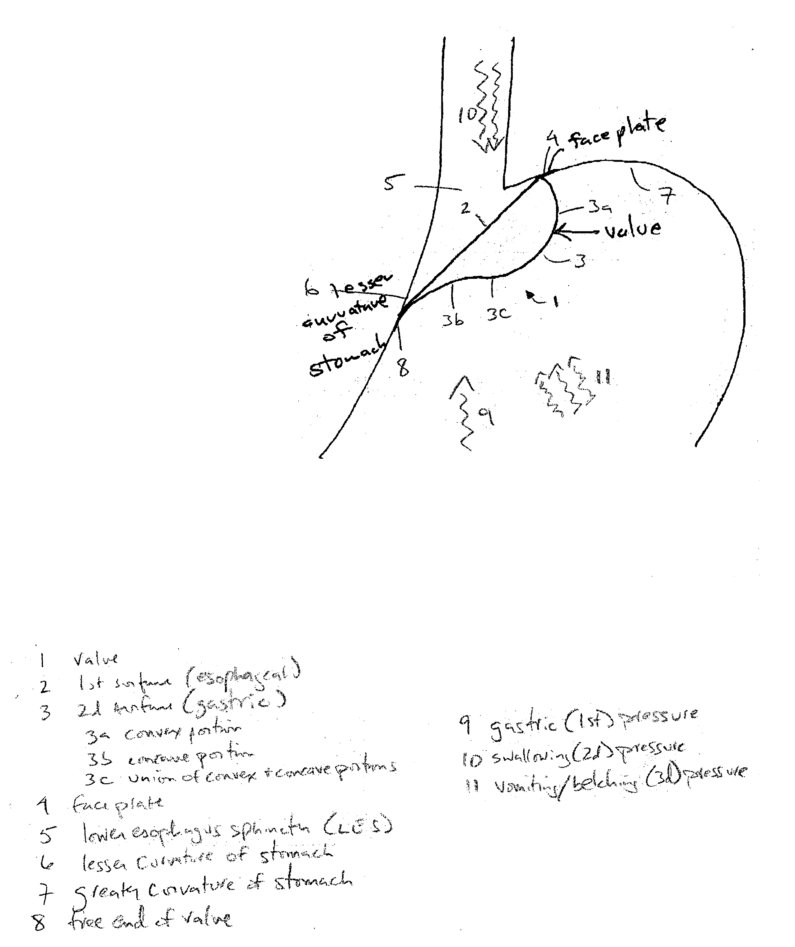 Device and method for treating gastroesophageal reflux disease