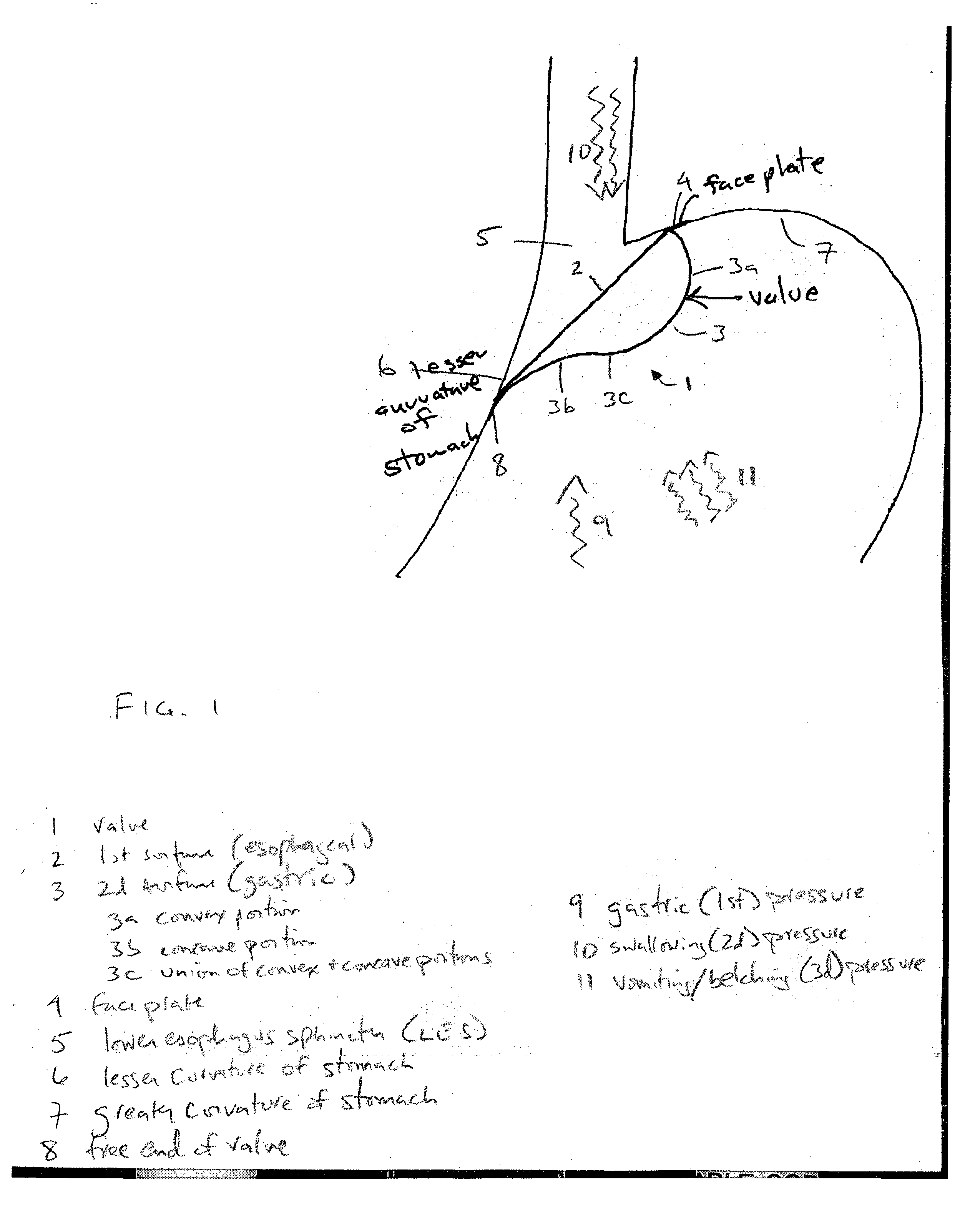 Device and method for treating gastroesophageal reflux disease