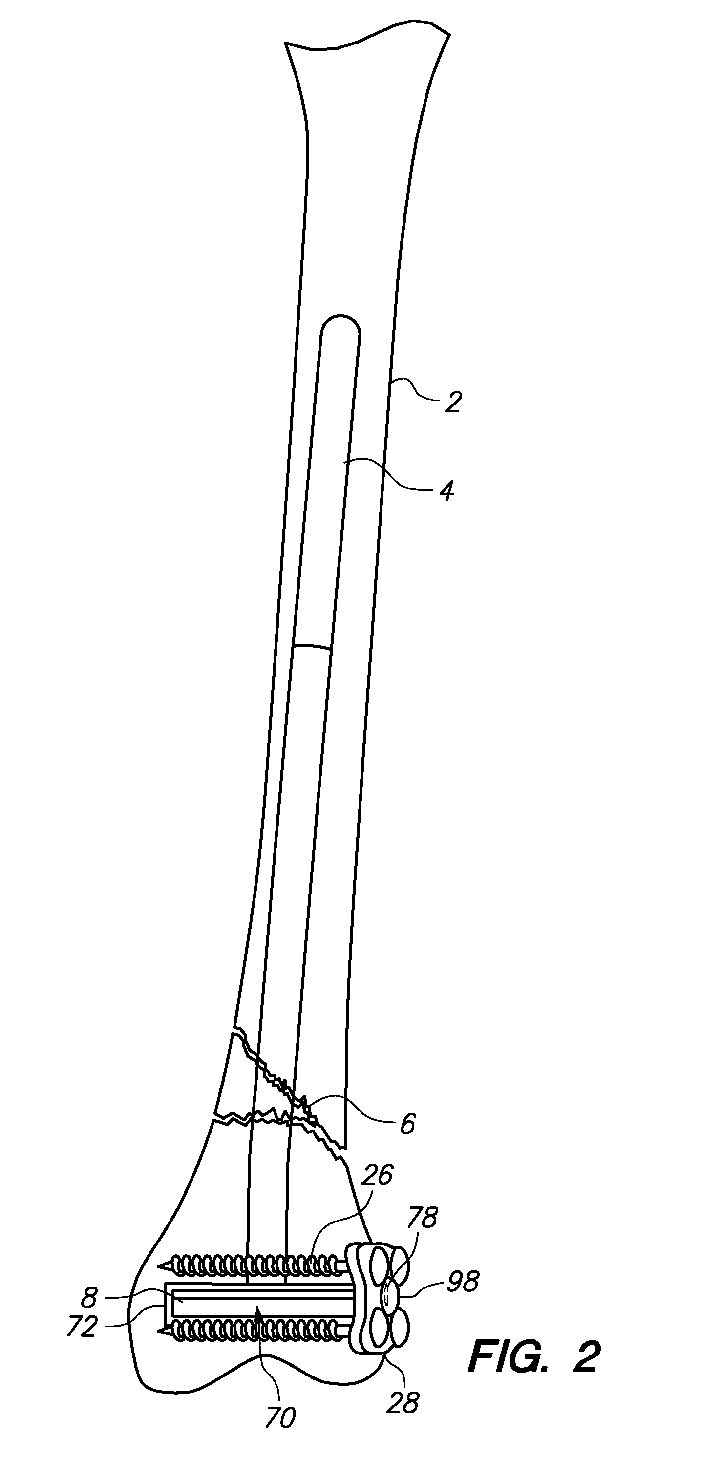 Bone Fixation Assemblies and Methods of Use