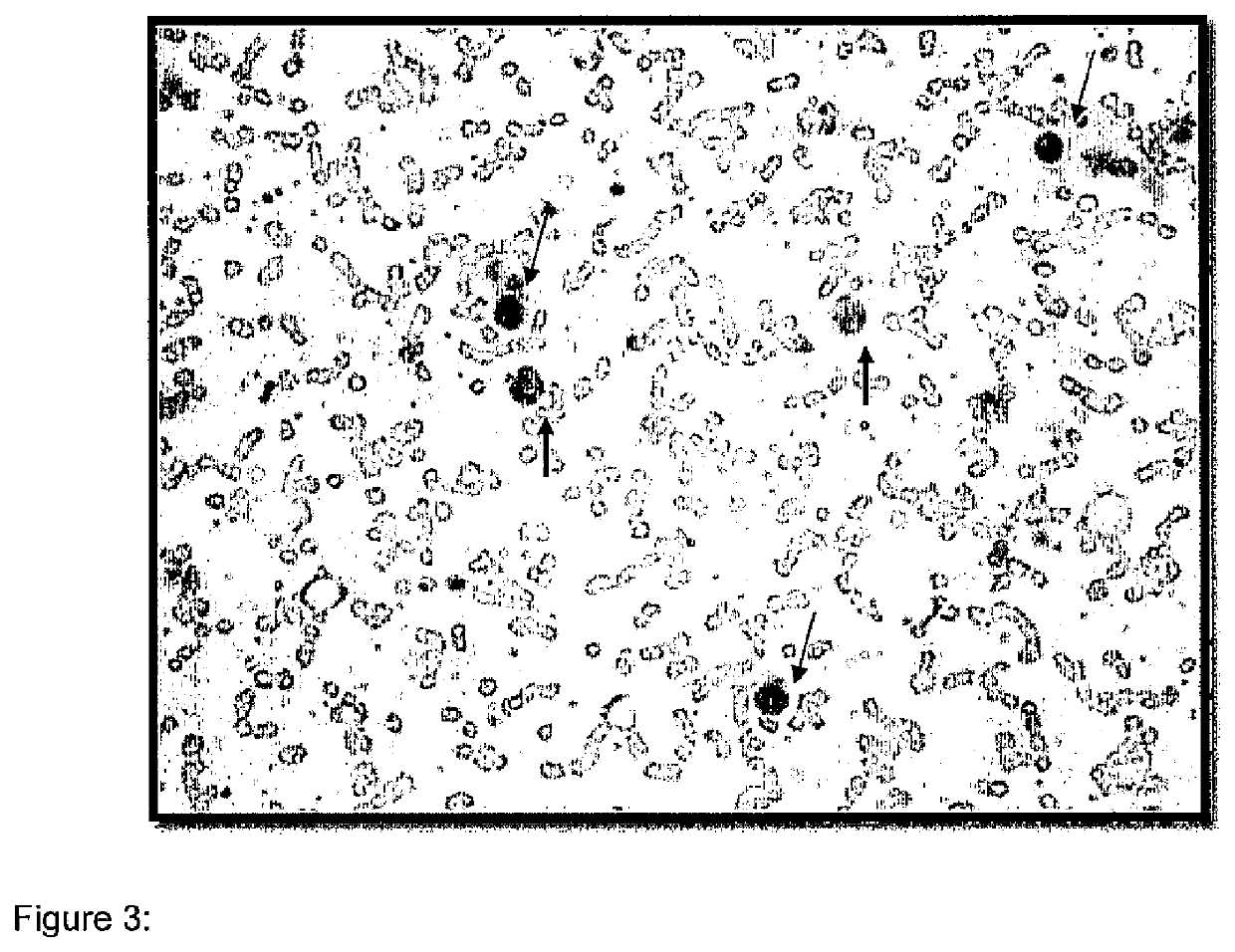 Methionine aminopeptidase overexpression in the peripheral blood and peripheral blood mononuclear cells is a marker for colorectal cancer screening, diagnosis and prognosis