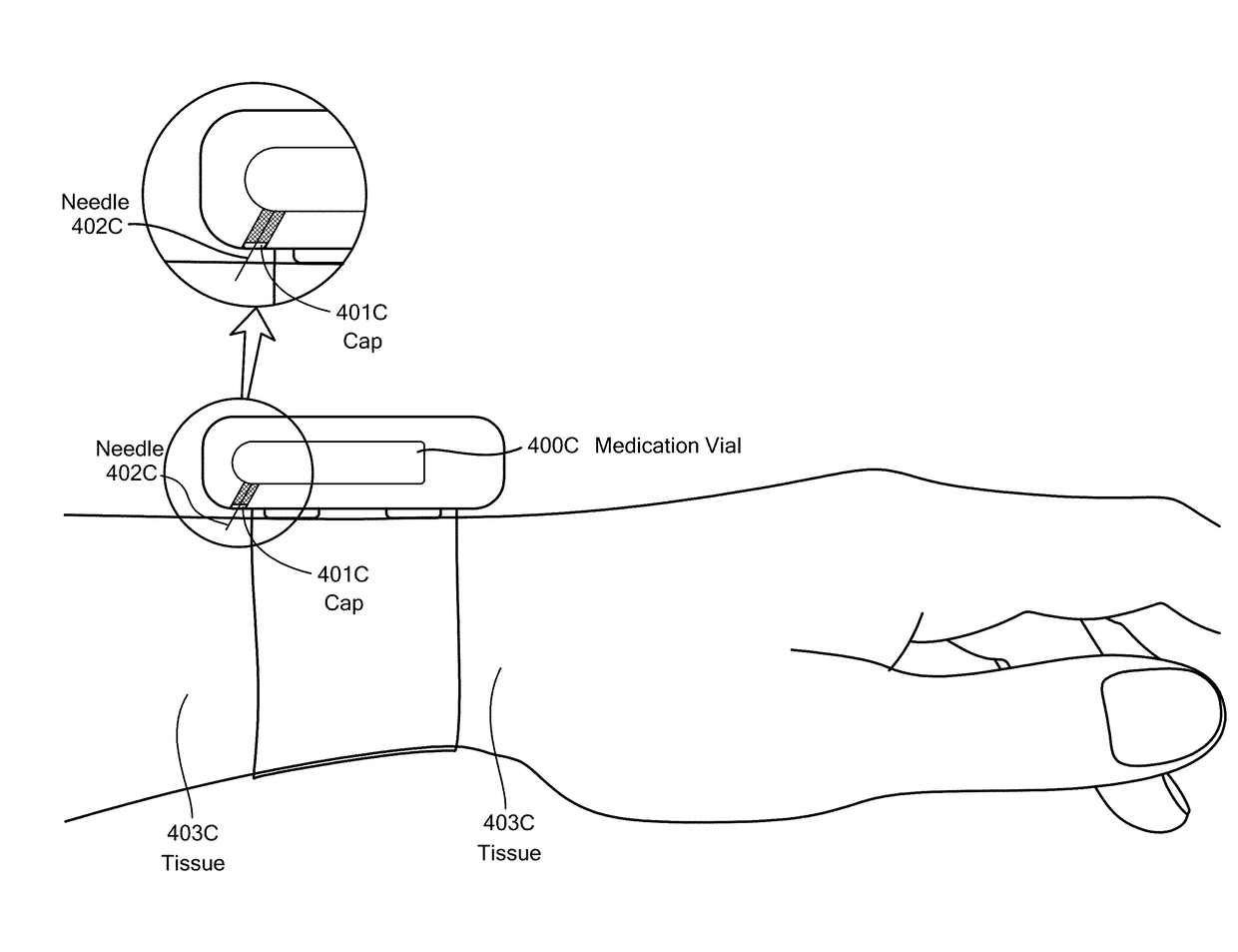 Method and Device for Automatic Identification of an Opioid Overdose and Injection of an Opioid Receptor Antagonist