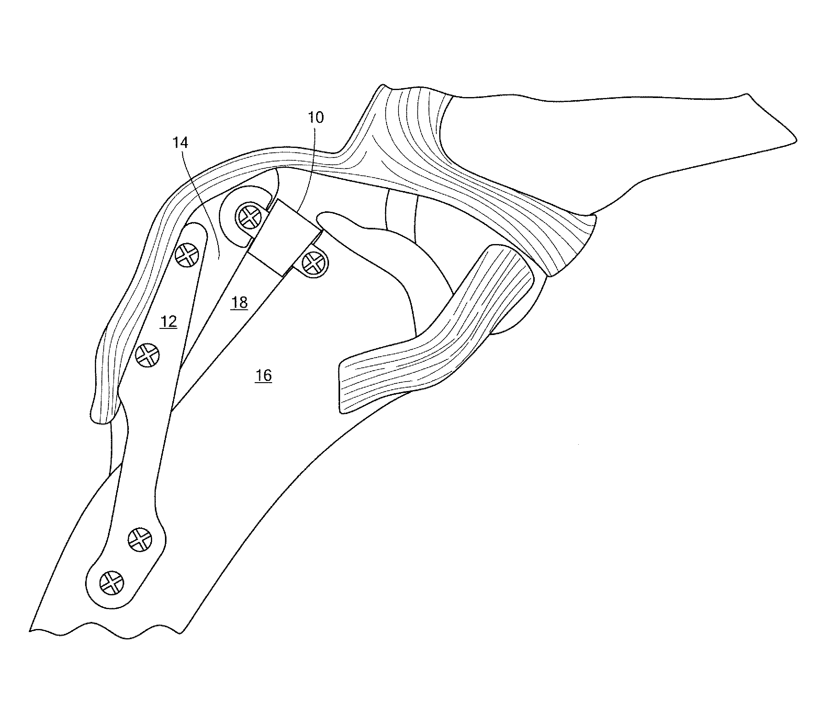 Tibial tuberosity advancement implant