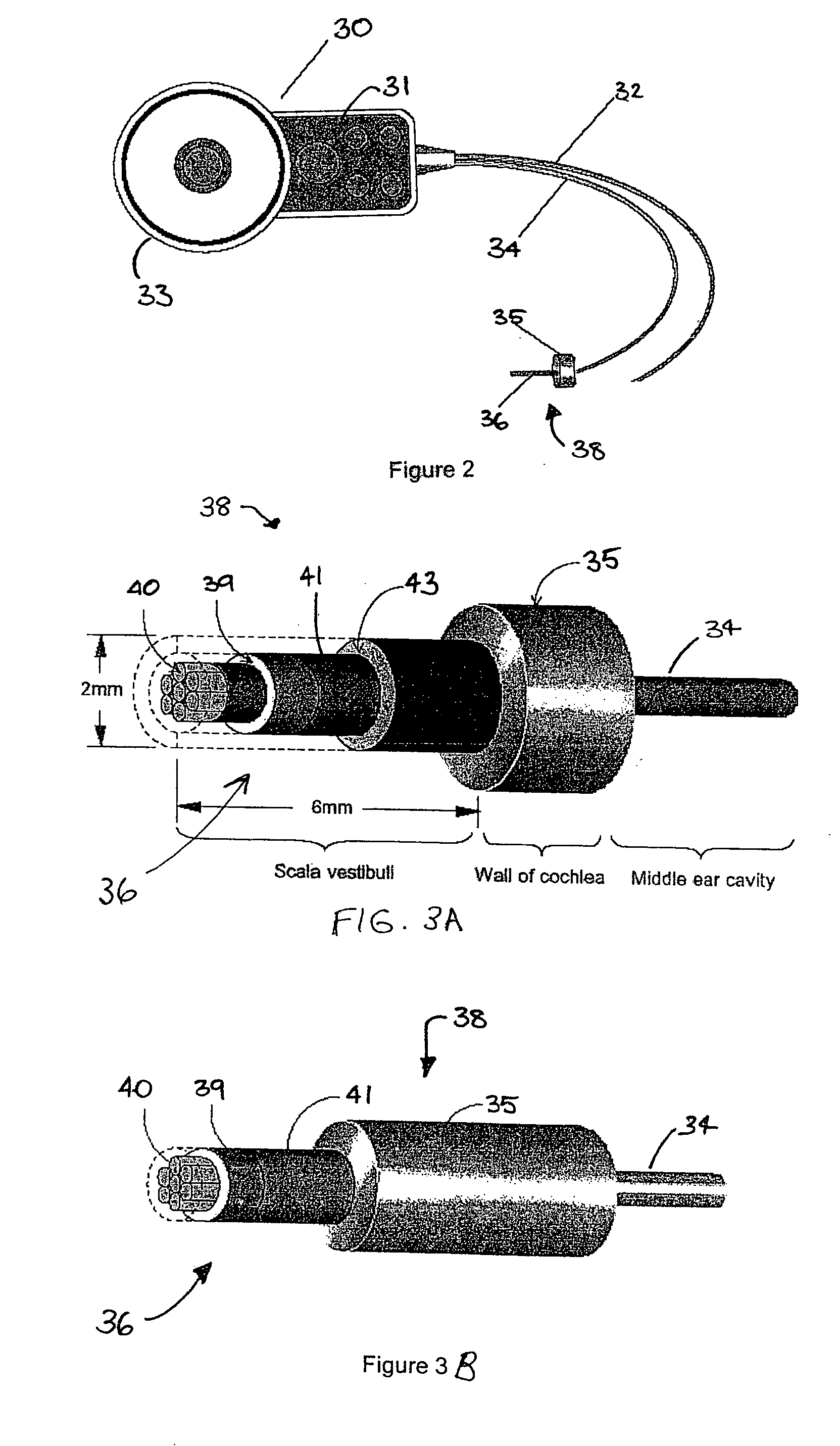 Implantable acoustic sensor