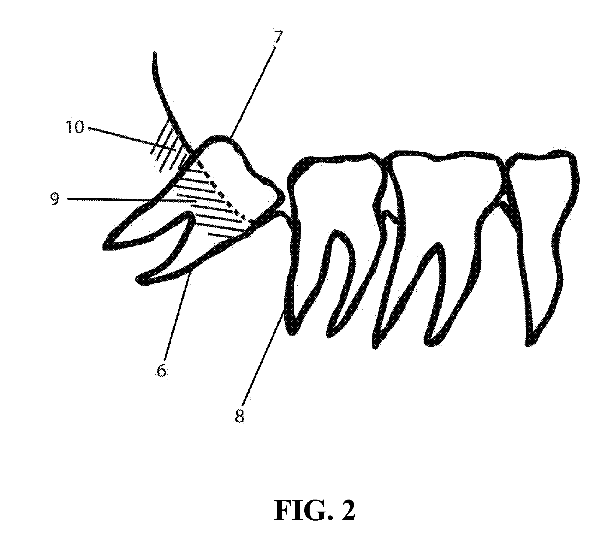 Device for loosening or extracting a wisdom tooth