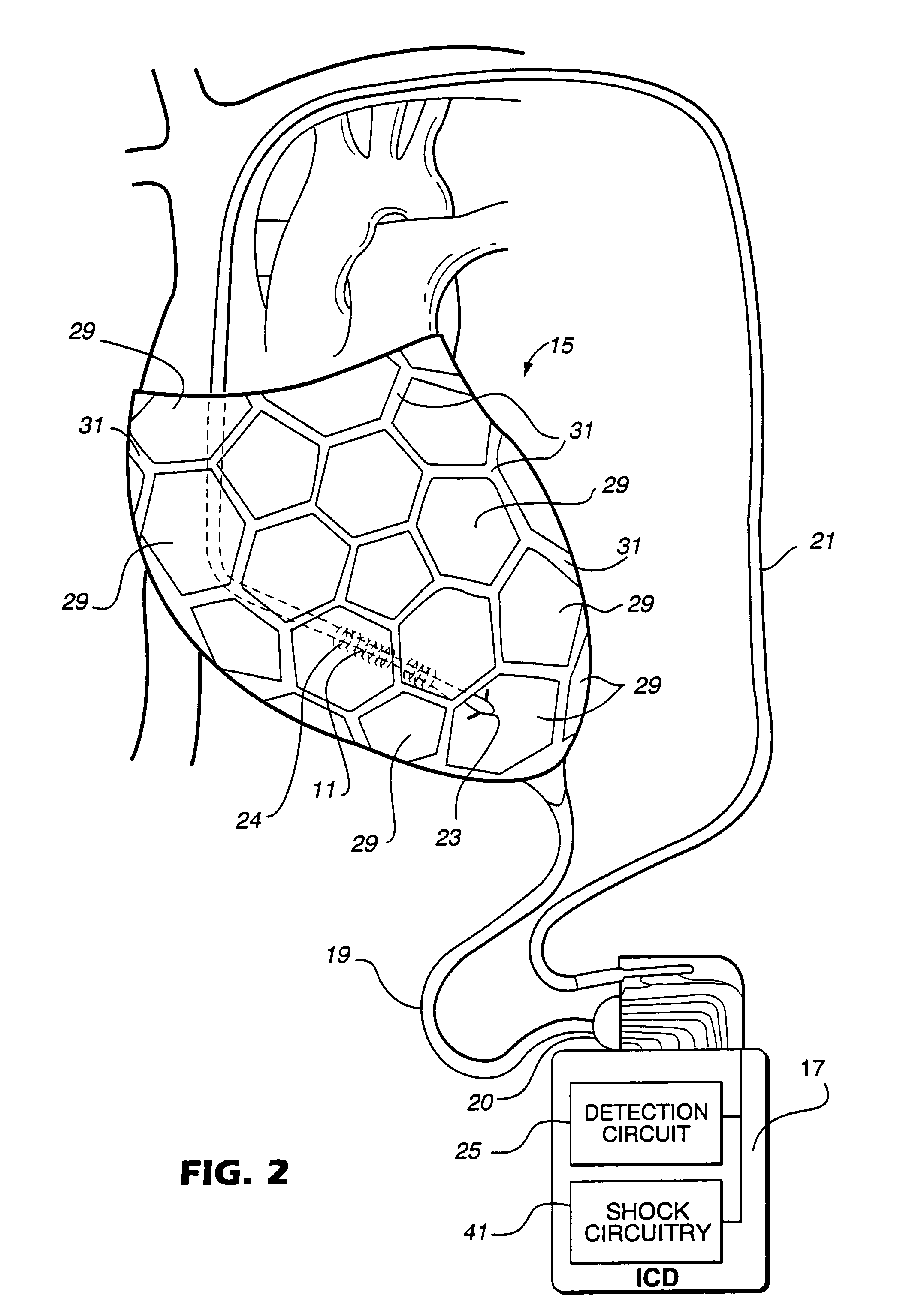 Cardiac shock electrode system and corresponding implantable defibrillator system