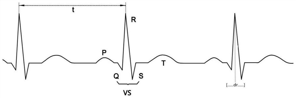 Implementable medical equipment with ventricular tachycardia diagnosis function