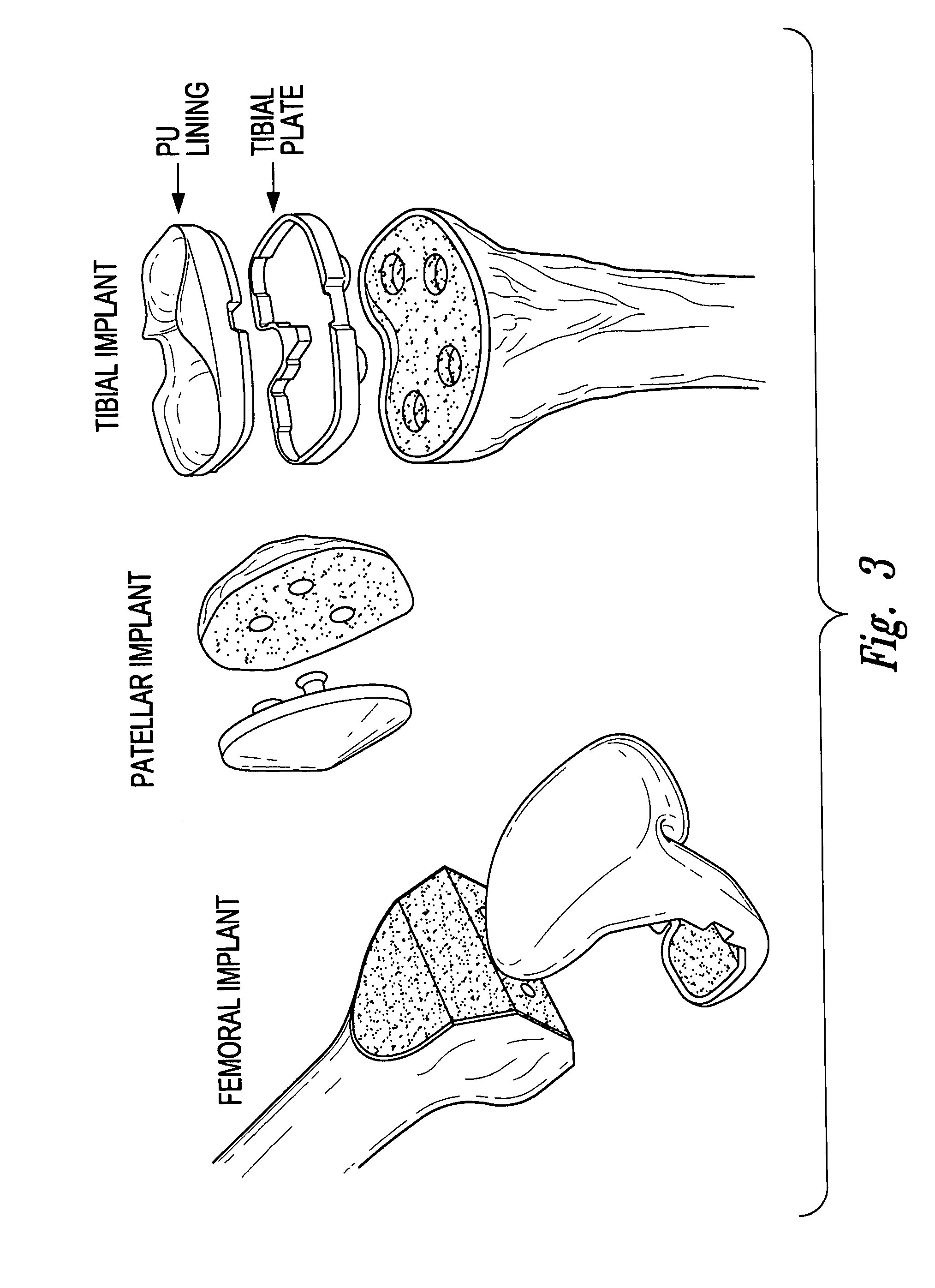 Devices, systems and methods for monitoring knee replacements