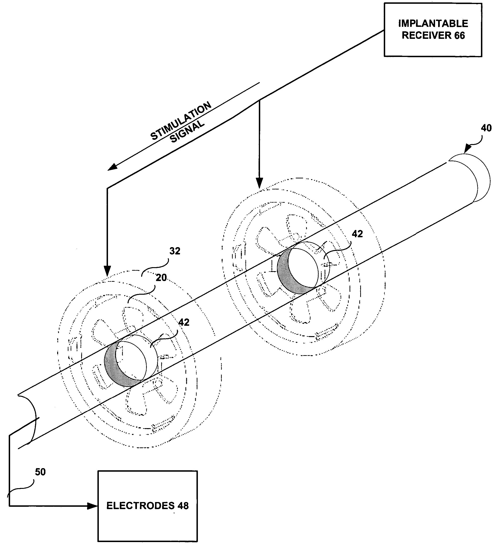 System and method of establishing an electrical connection between an implanted lead and an electrical contact