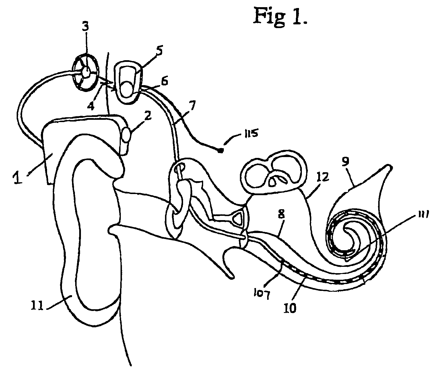 Peak-derived timing stimulation strategy for a multi-channel cochlear implant