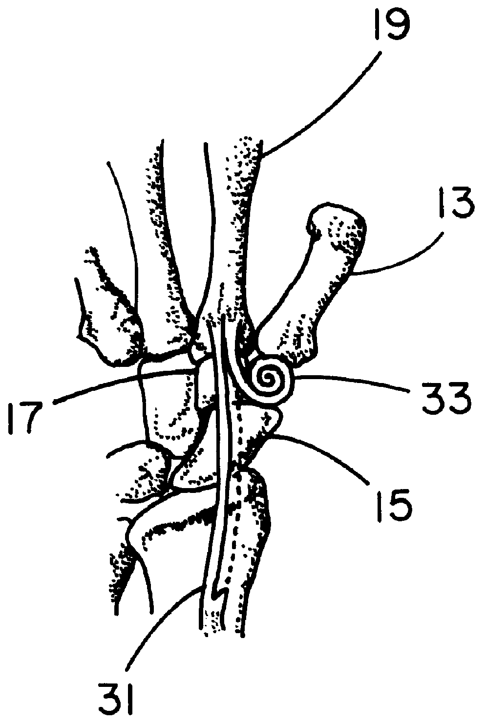 Resorbable interposition arthroplasty implant