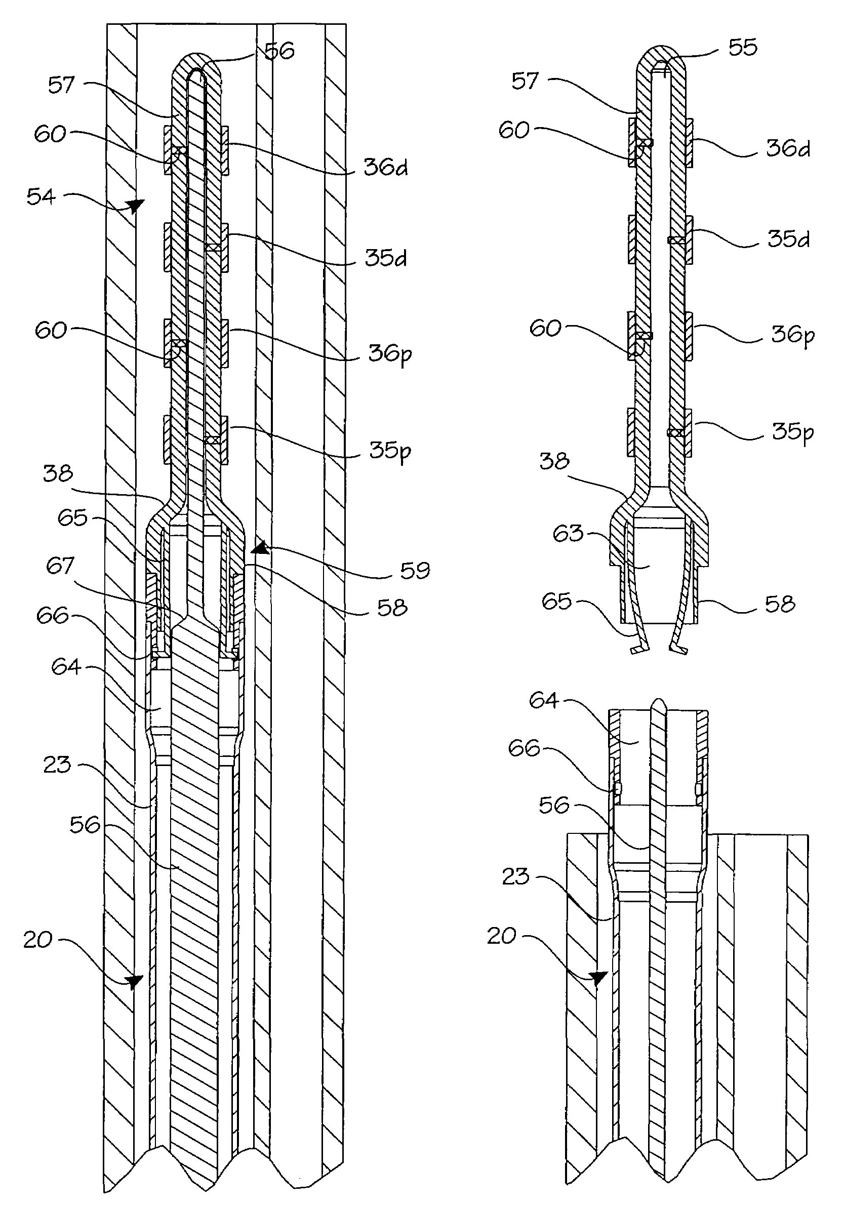 Method and apparatus for tubal occlusion